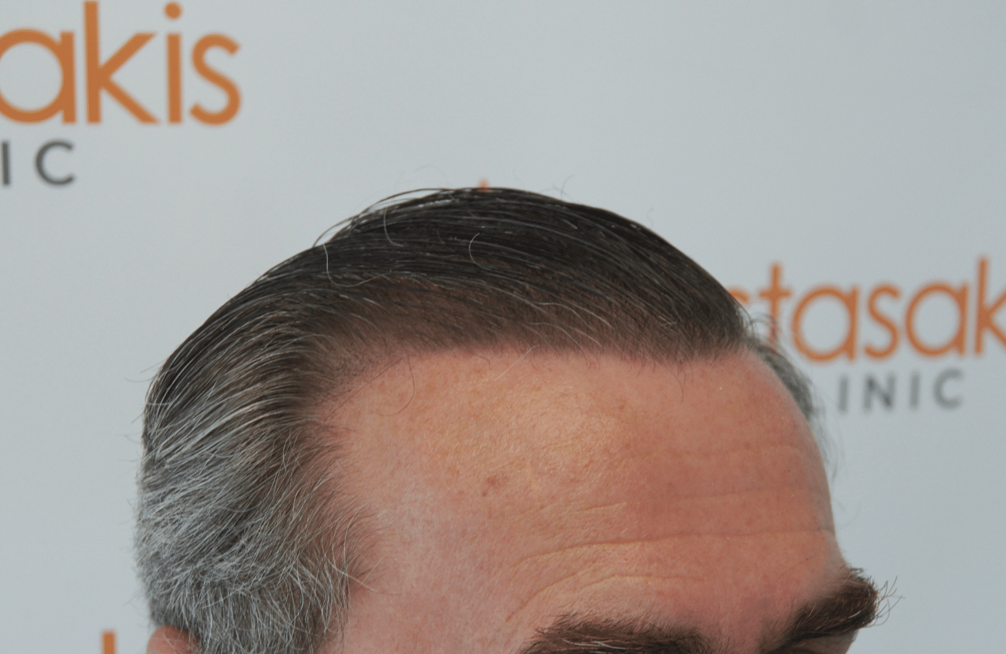 best hair transplant result with 3500 fus male fue anastasakis hair clinic