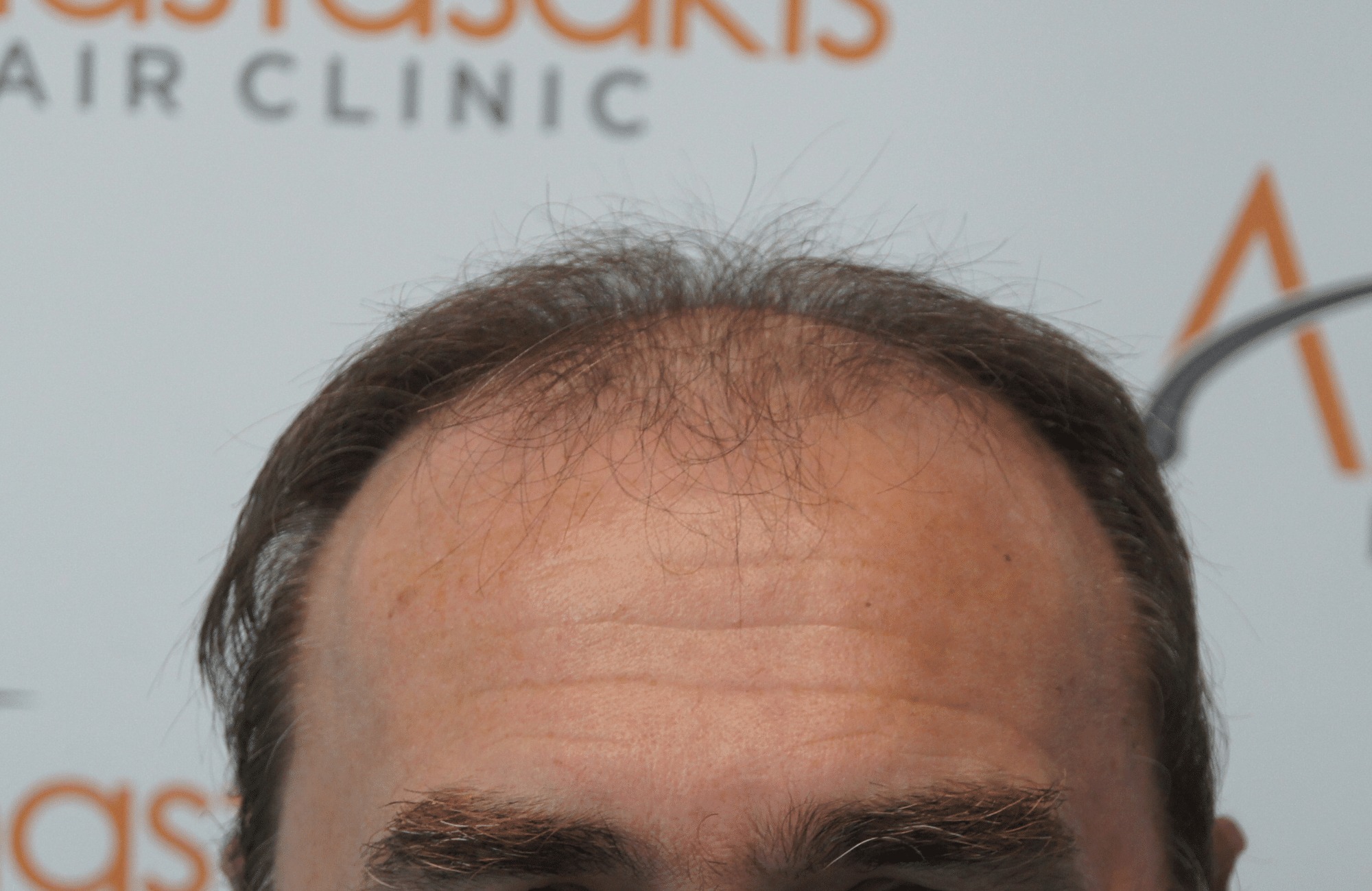 best hair transplant result with 3500 fus male fue anastasakis hair clinic