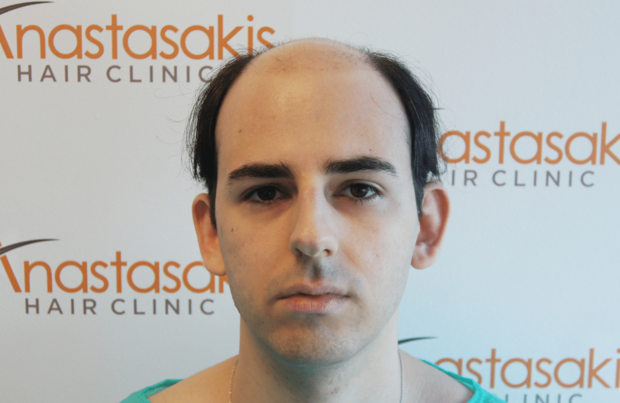 best hair transplant result with 3000 fus male fue anastasakis hair clinic