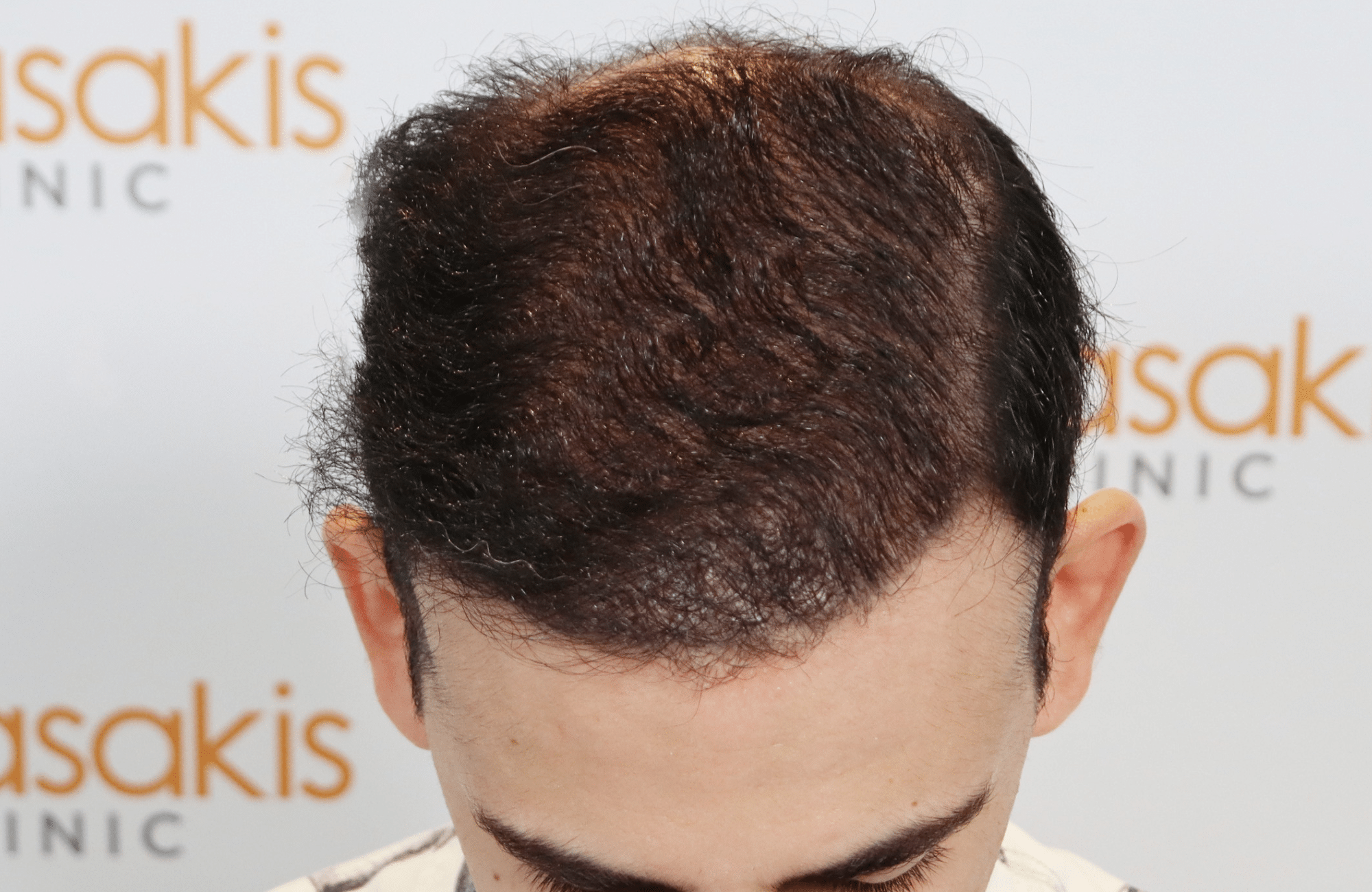 best hair transplant result with 3000 fus male fue anastasakis hair clinic