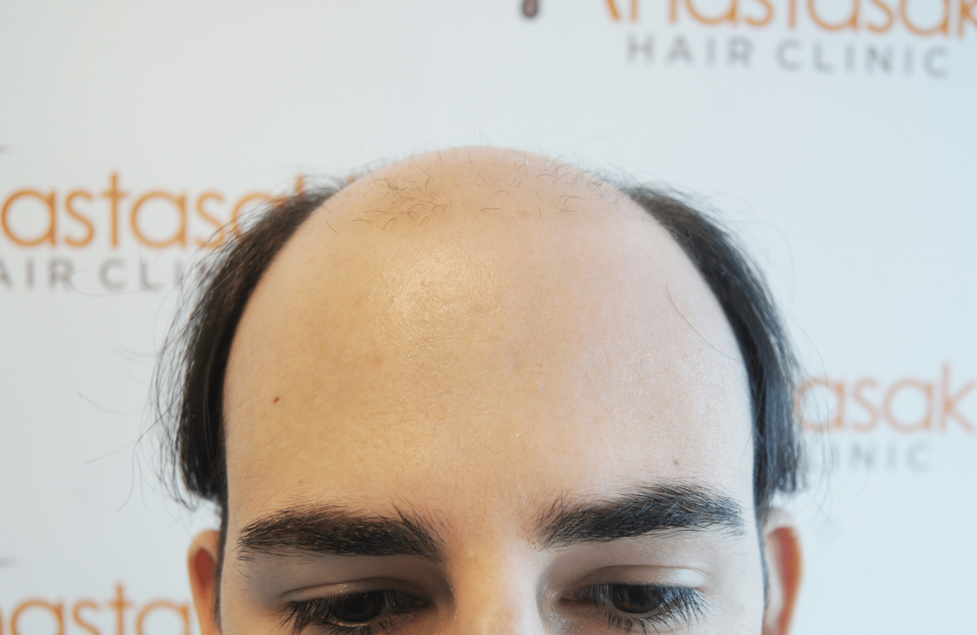 best hair transplant result with 3000 fus male fue anastasakis hair clinic