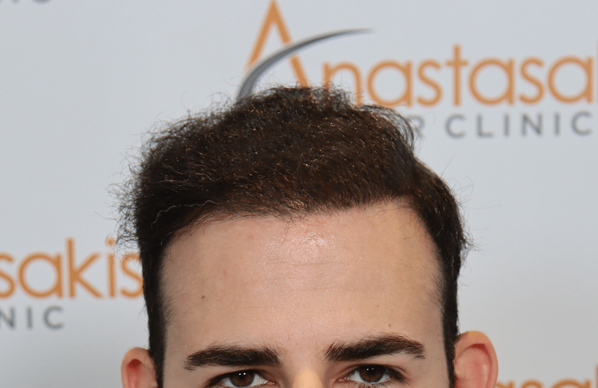 best hair transplant result with 3000 fus male fue anastasakis hair clinic
