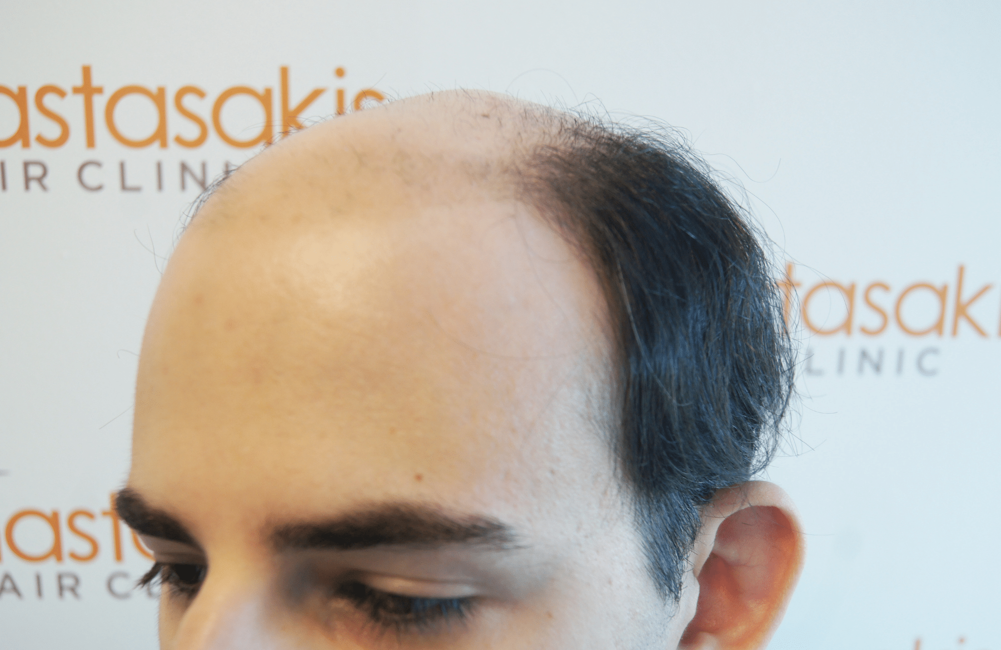 best hair transplant result with 3000 fus male fue anastasakis hair clinic