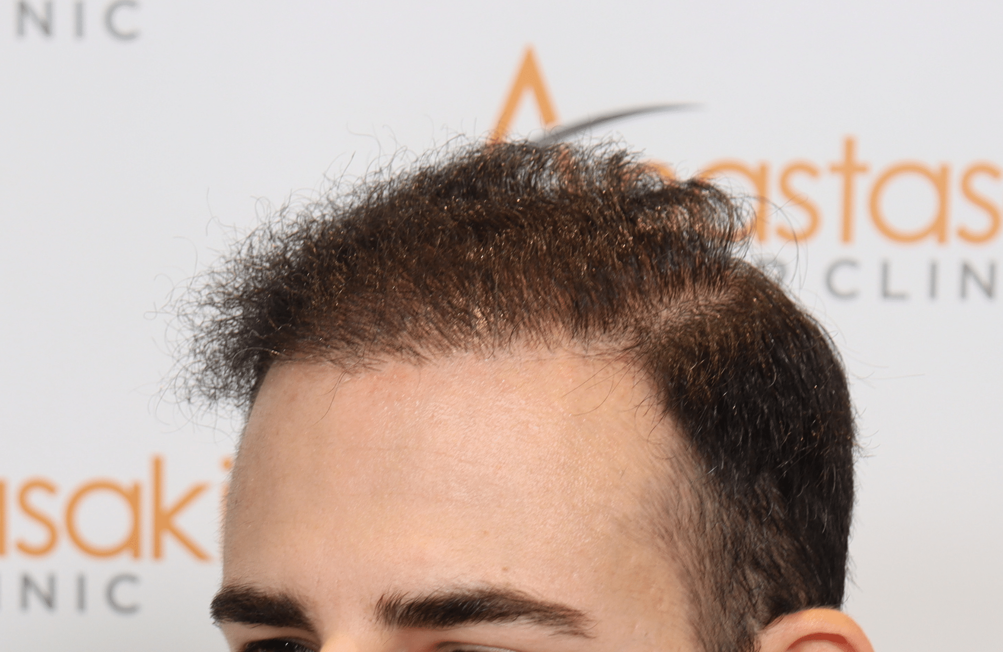 best hair transplant result with 3000 fus male fue anastasakis hair clinic