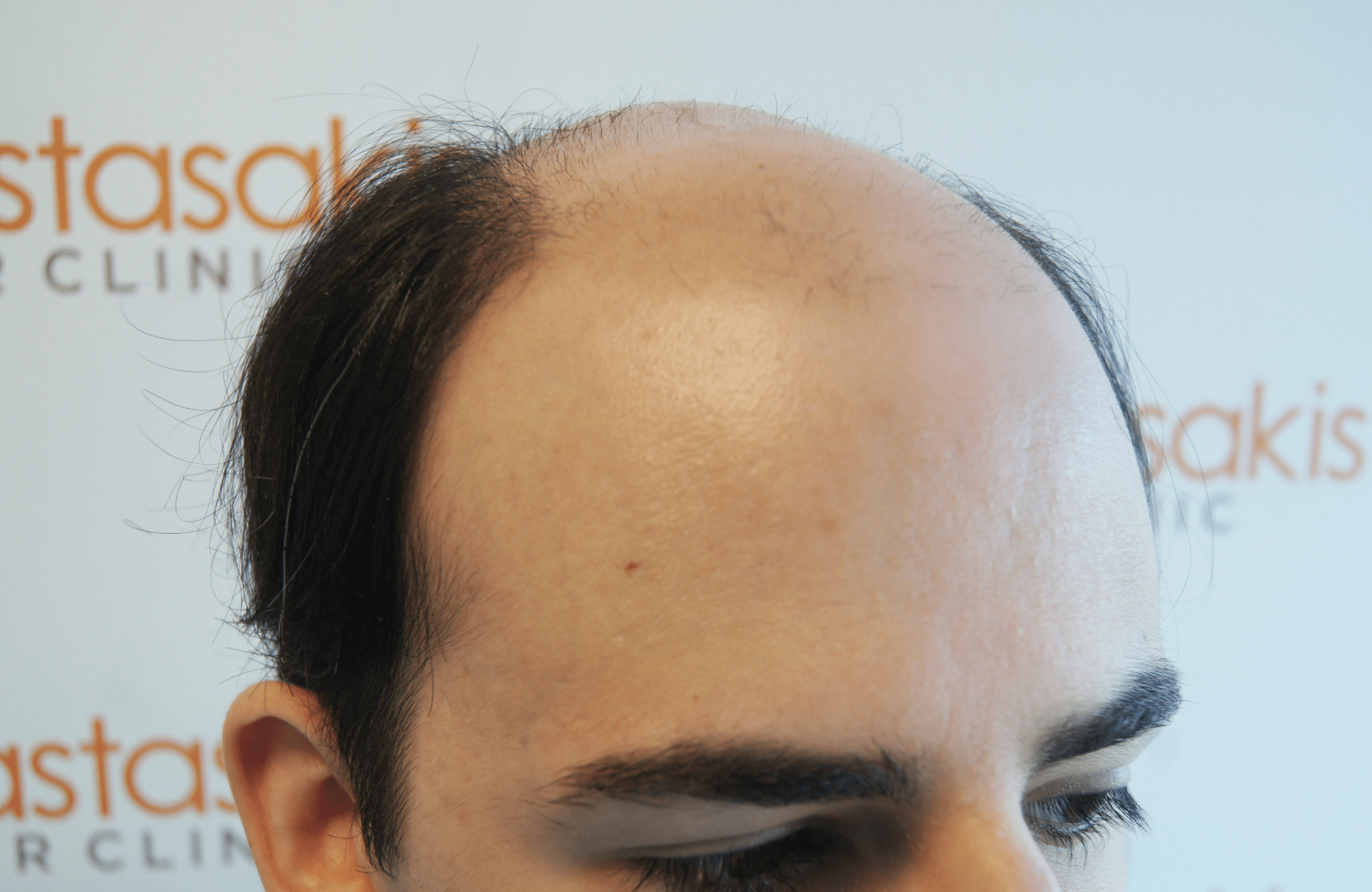 best hair transplant result with 3000 fus male fue anastasakis hair clinic