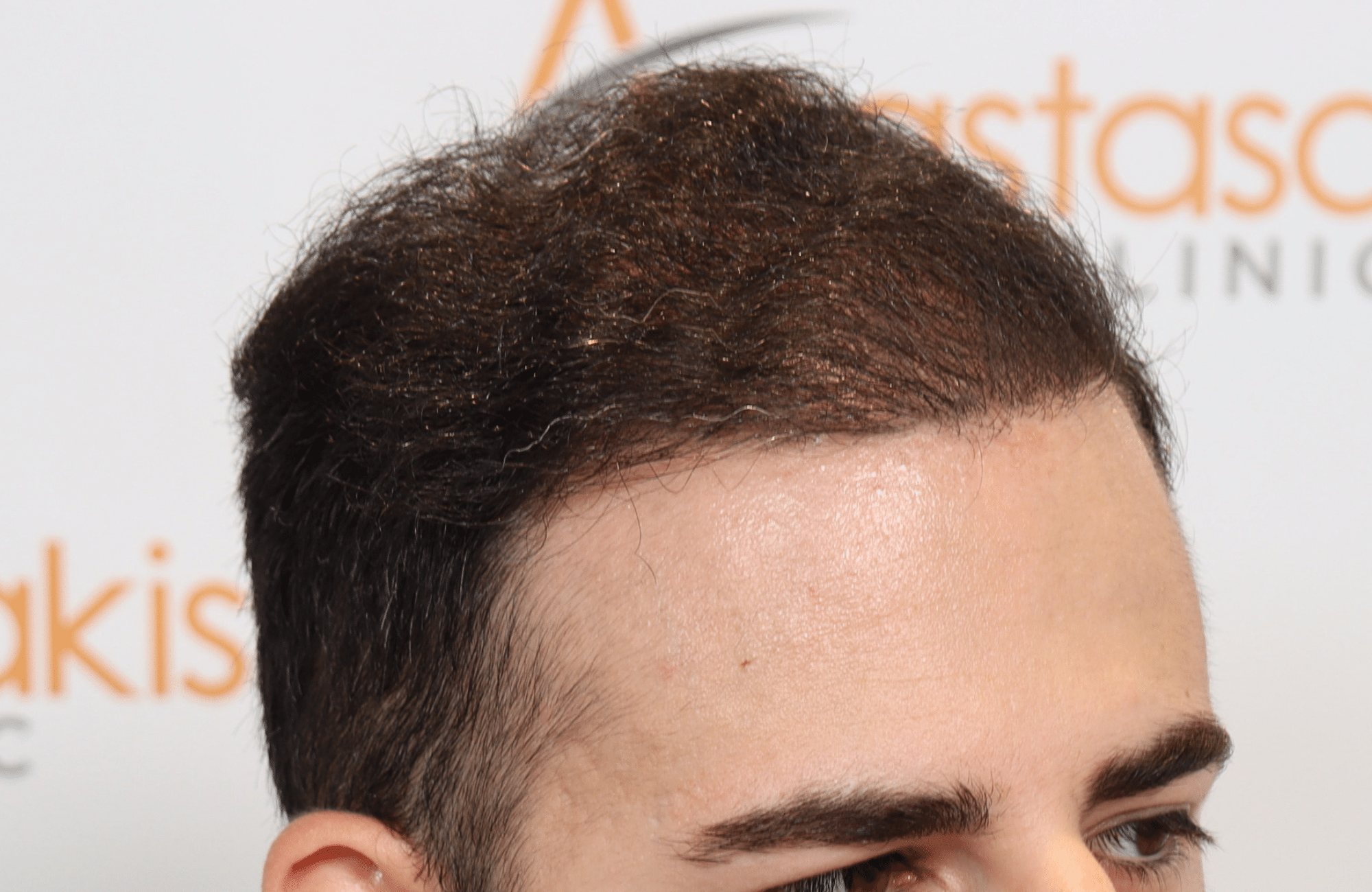 best hair transplant result with 3000 fus male fue anastasakis hair clinic