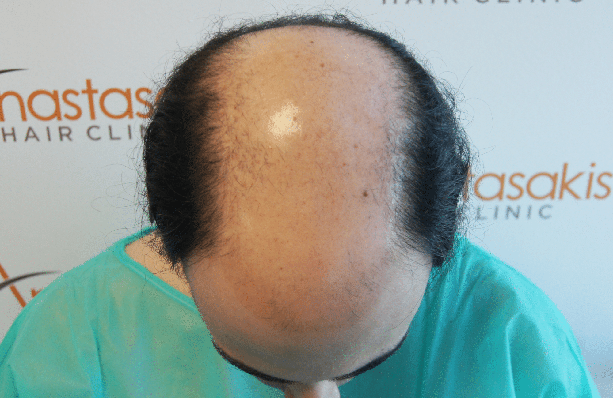 best hair transplant result with 3000 fus male fue anastasakis hair clinic