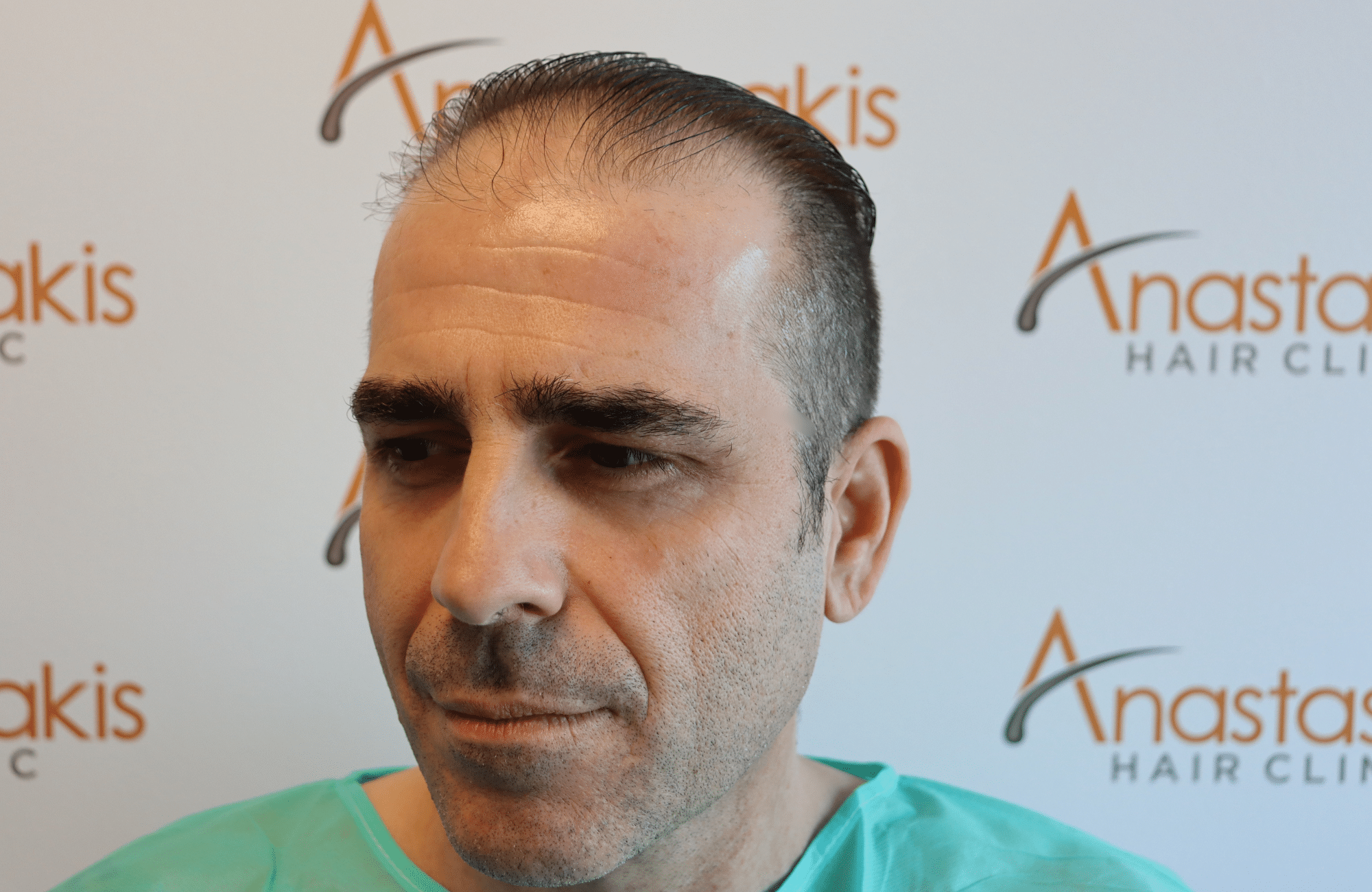 hair transplant result (11)