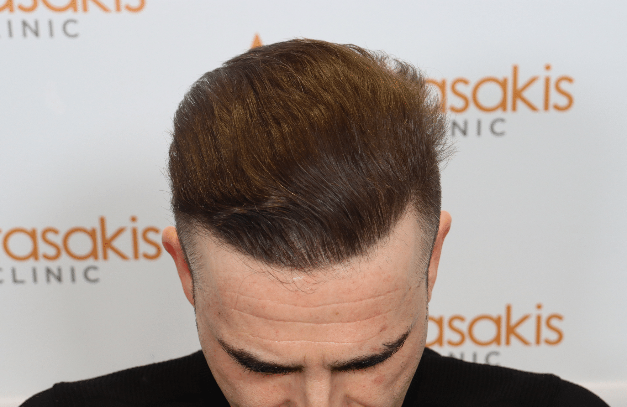 hair transplant result (13)