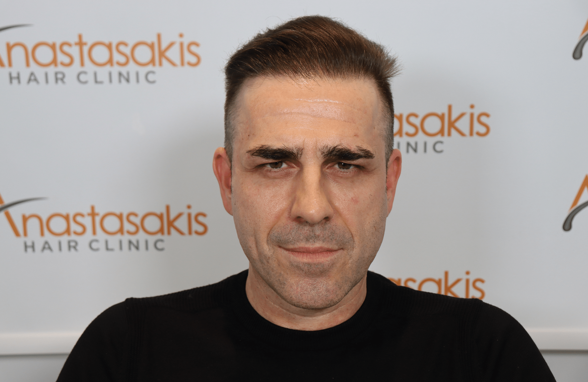 hair transplant result (3)