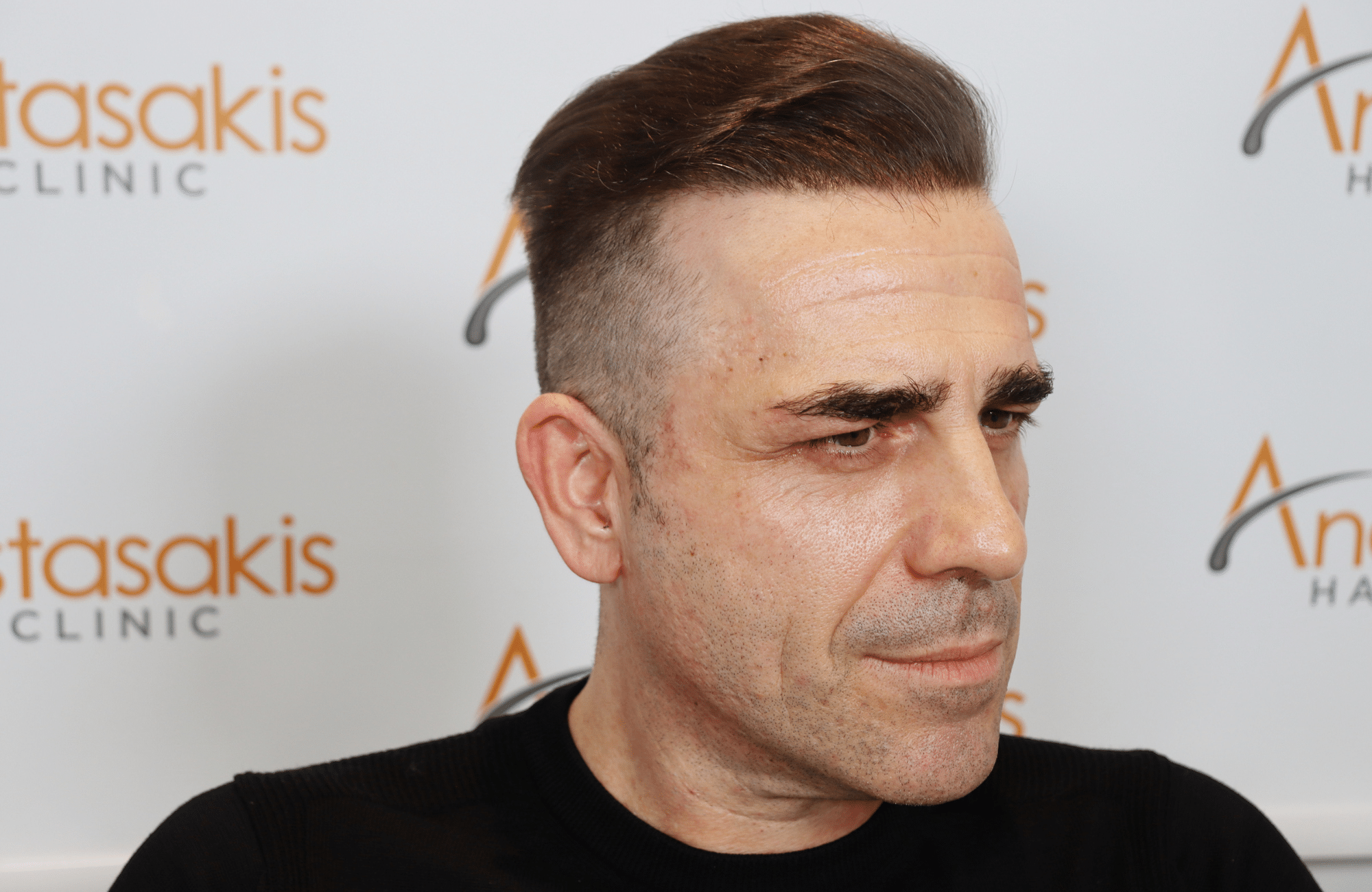 hair transplant result (4)