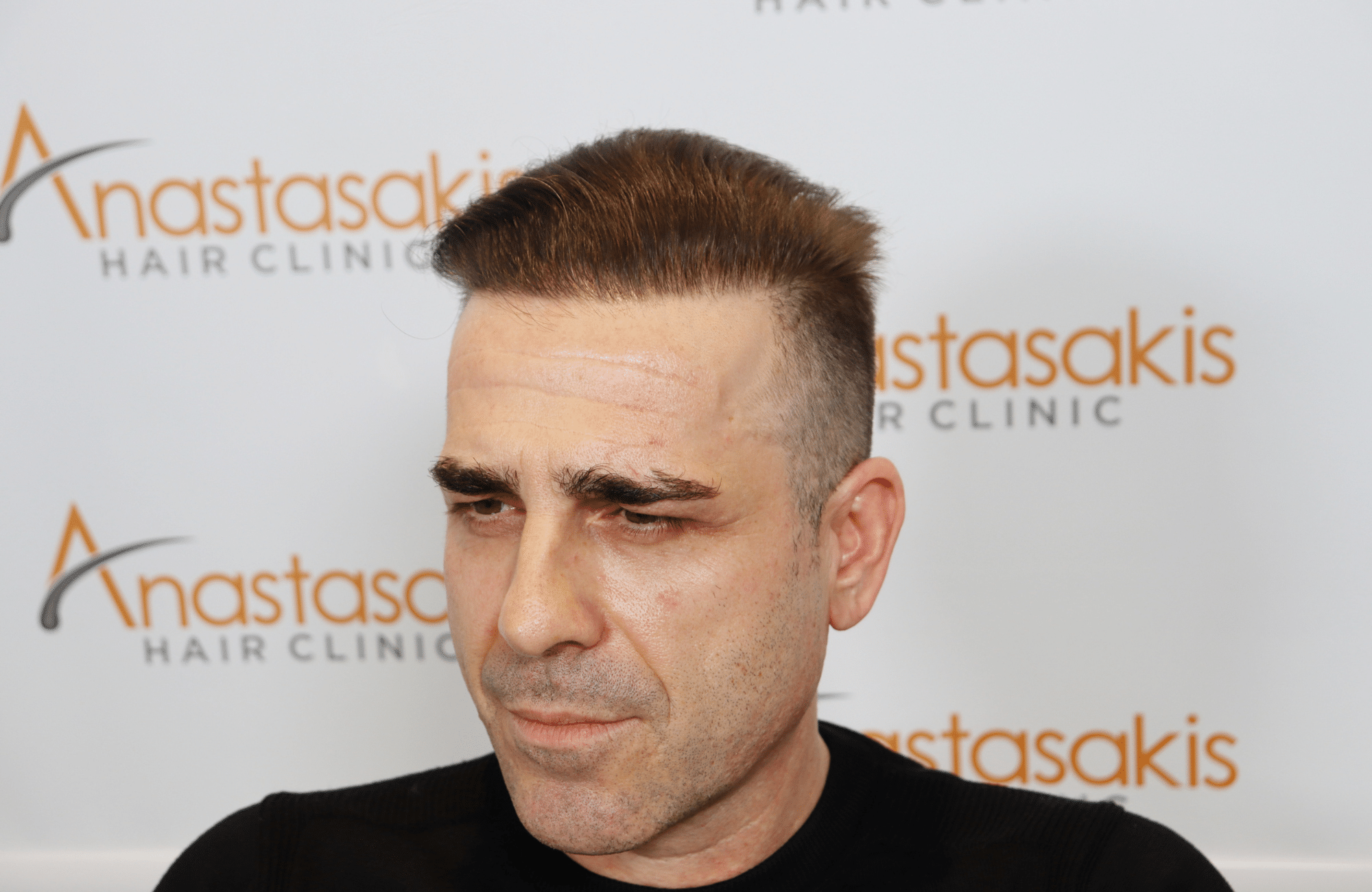 hair transplant result (5)