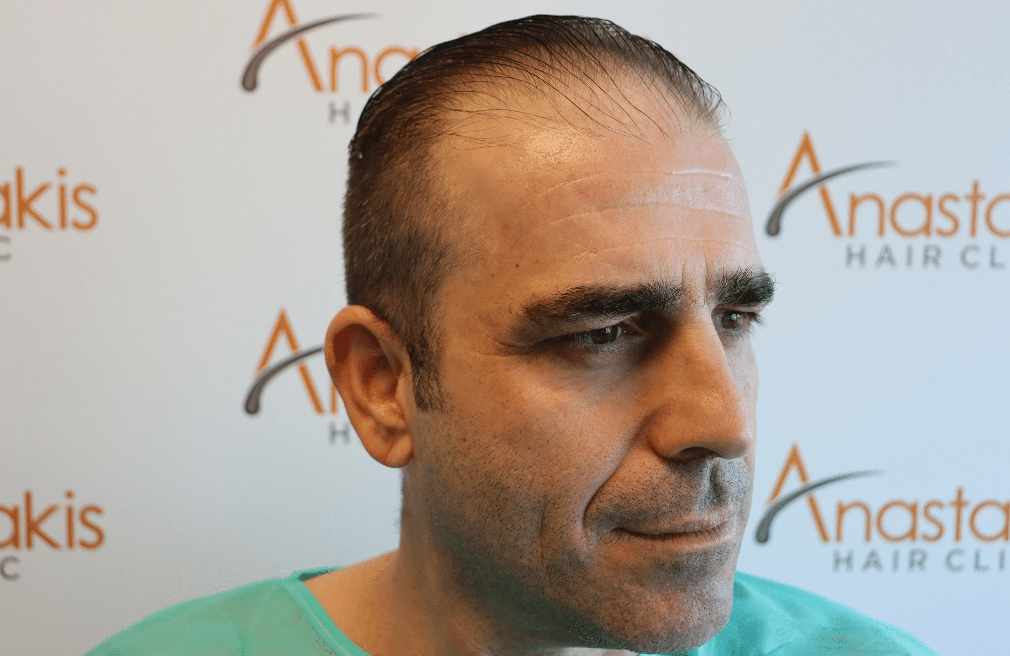 hair transplant result (7)