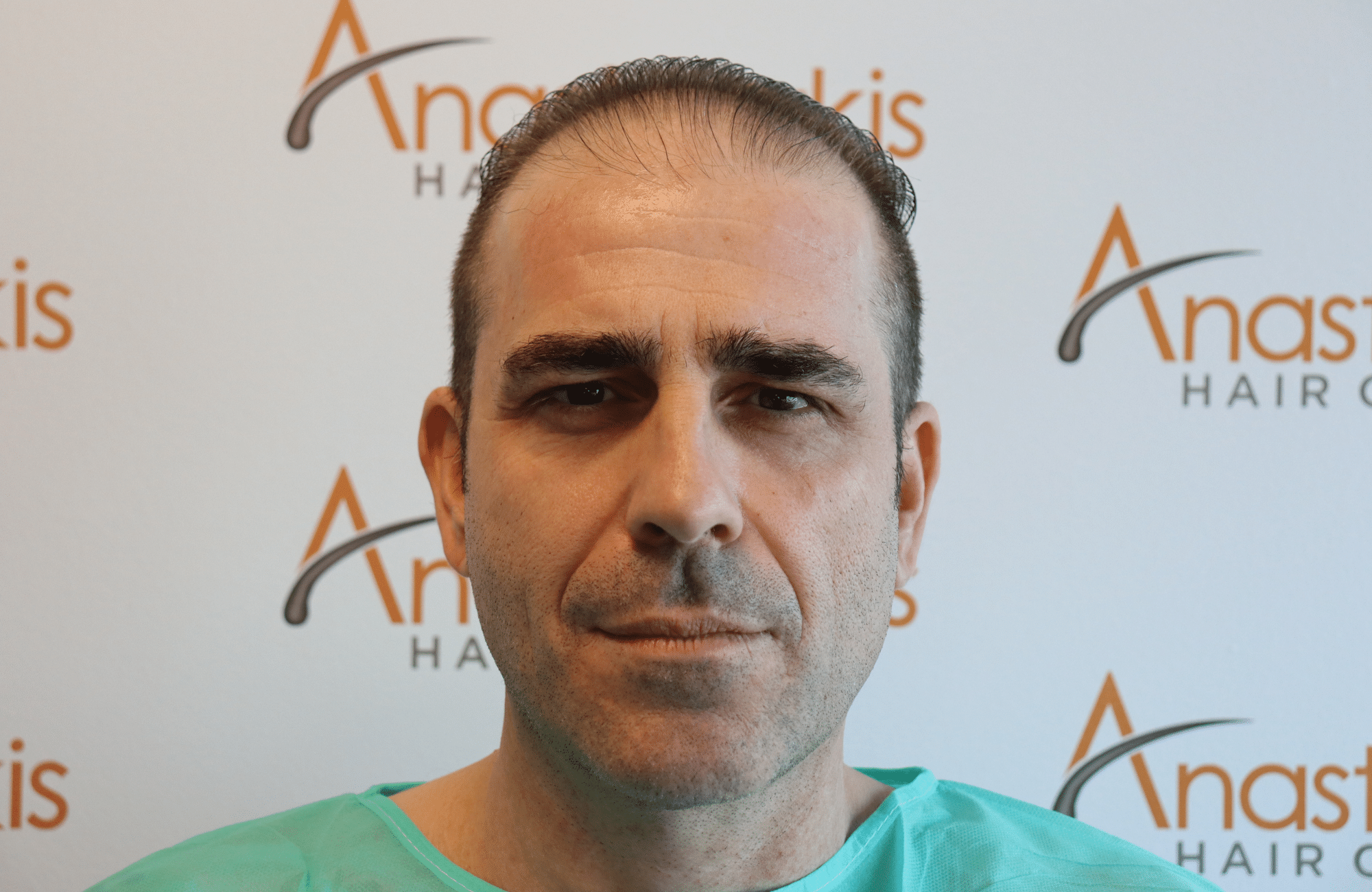 hair transplant result (8)