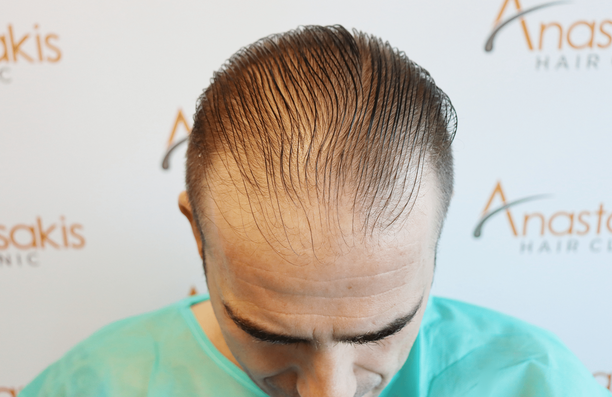 hair transplant result (9)