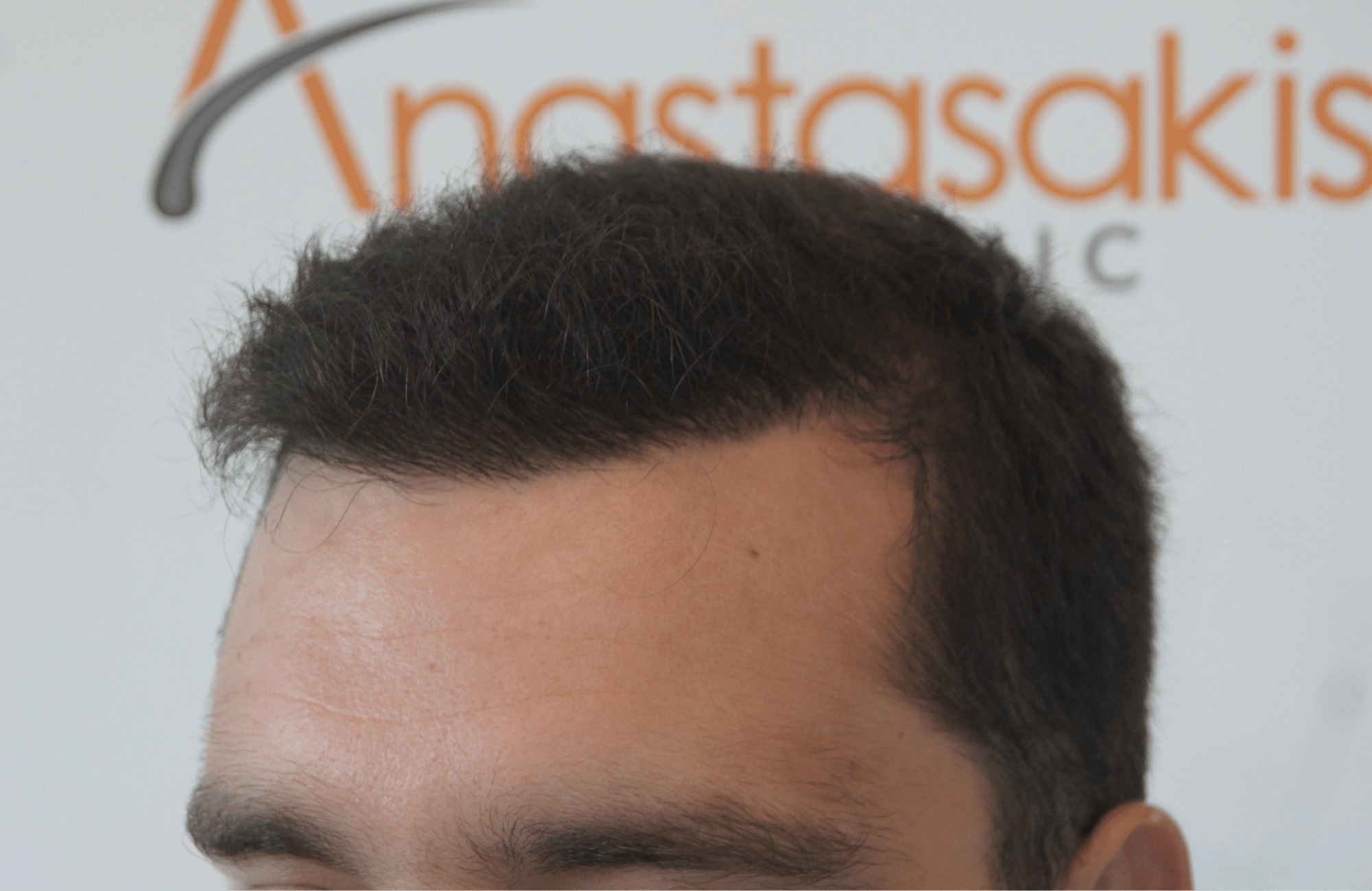 best hair transplant result with 3000 fus male fue anastasakis hair clinic