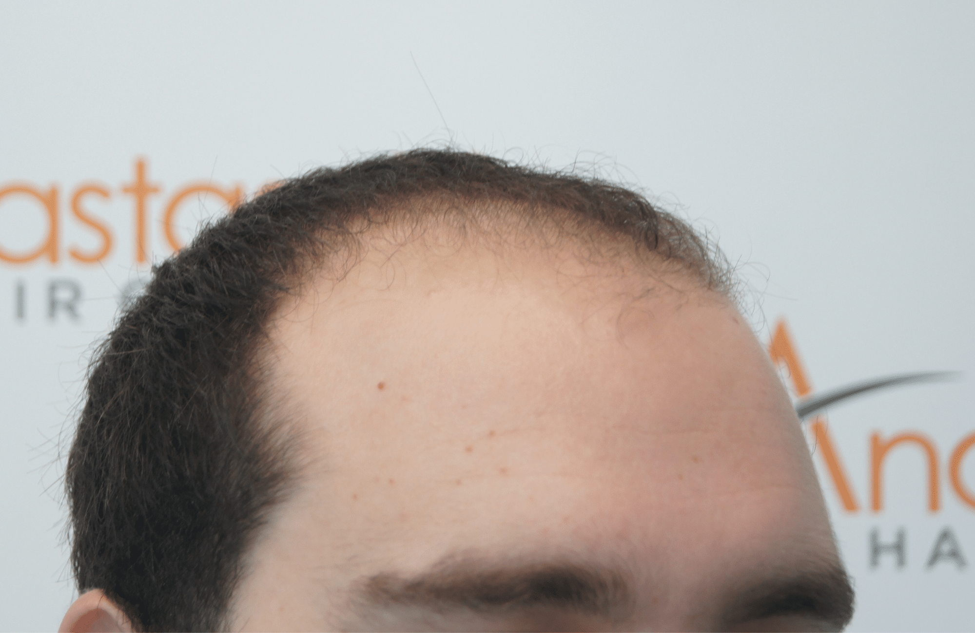 best hair transplant result with 3000 fus male fue anastasakis hair clinic