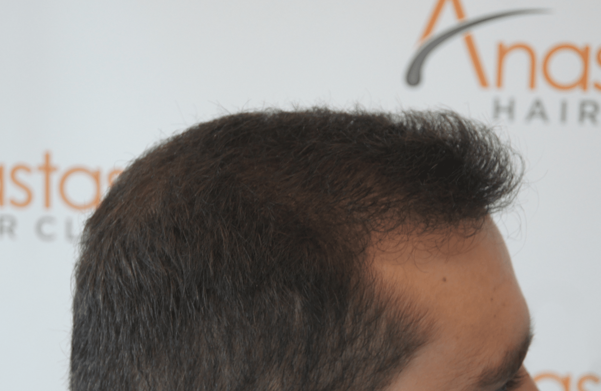 best hair transplant result with 3000 fus male fue anastasakis hair clinic