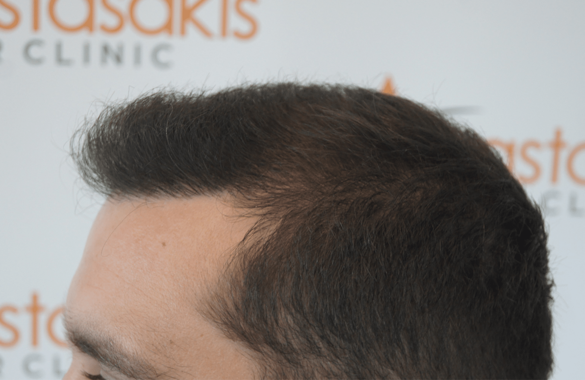 best hair transplant result with 3000 fus male fue anastasakis hair clinic