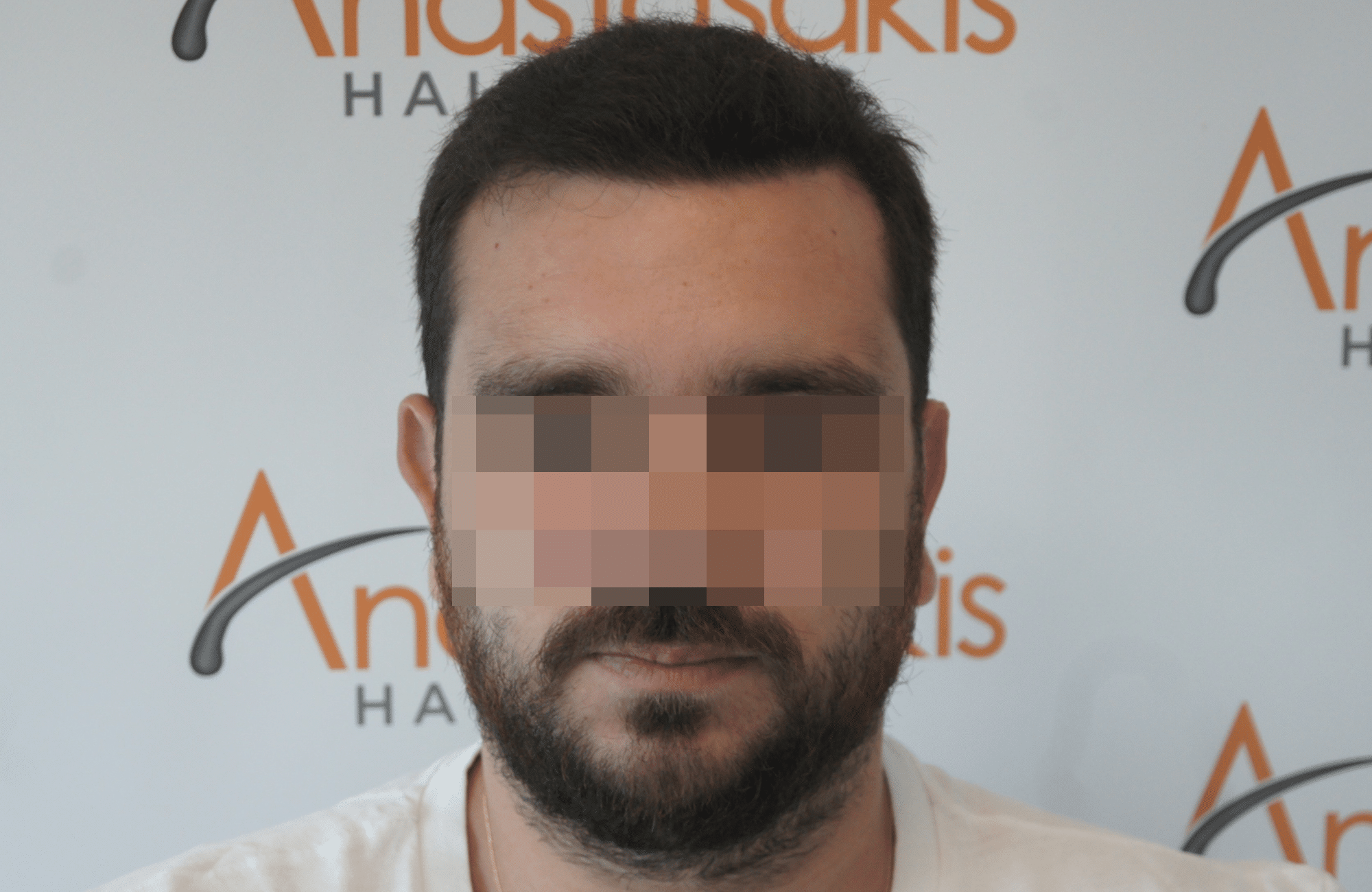 best hair transplant result with 3000 fus male fue anastasakis hair clinic