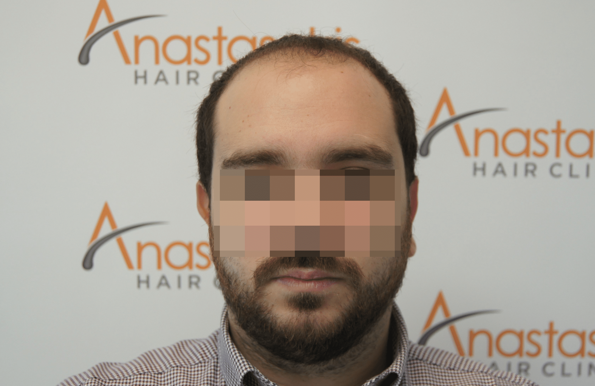 best hair transplant result with 3000 fus male fue anastasakis hair clinic