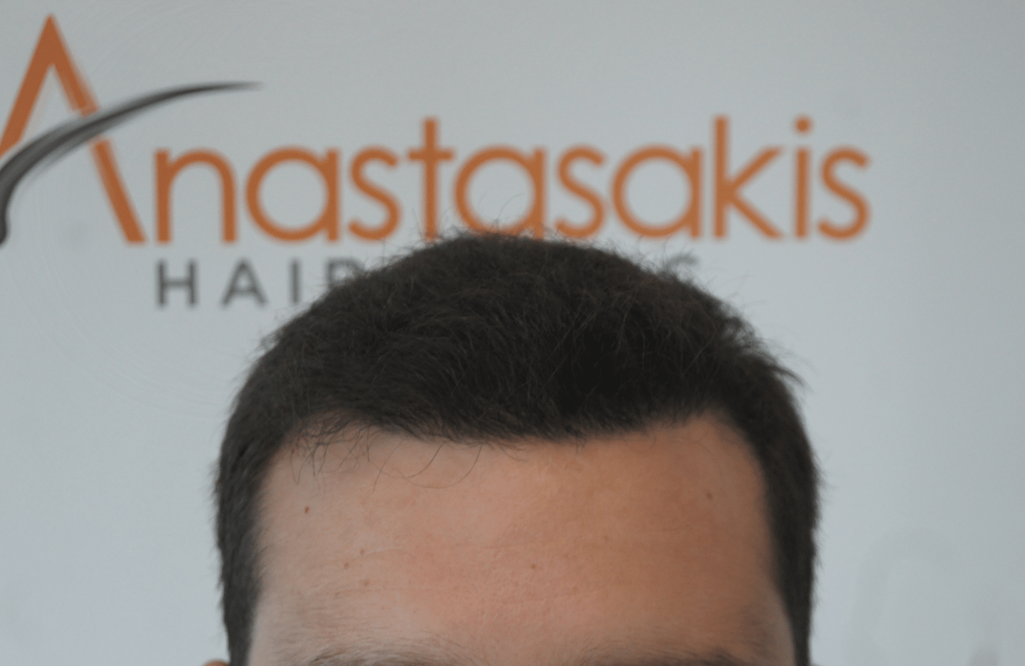 best hair transplant result with 3000 fus male fue anastasakis hair clinic