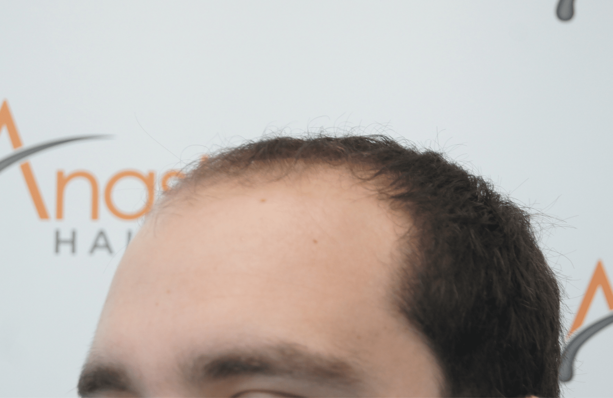 best hair transplant result with 3000 fus male fue anastasakis hair clinic