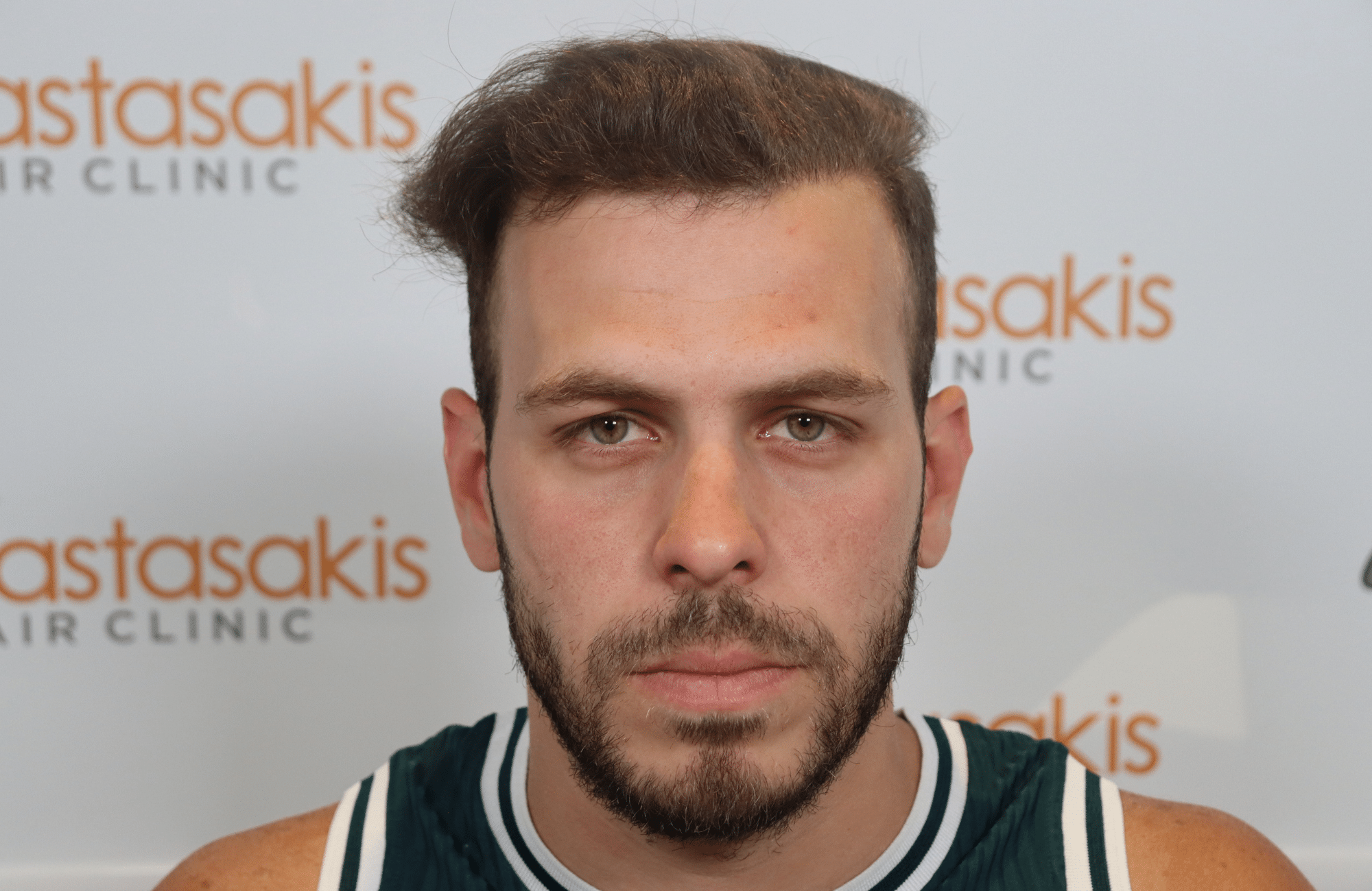 best hair transplant result with 2000 fus male fue anastasakis hair clinic