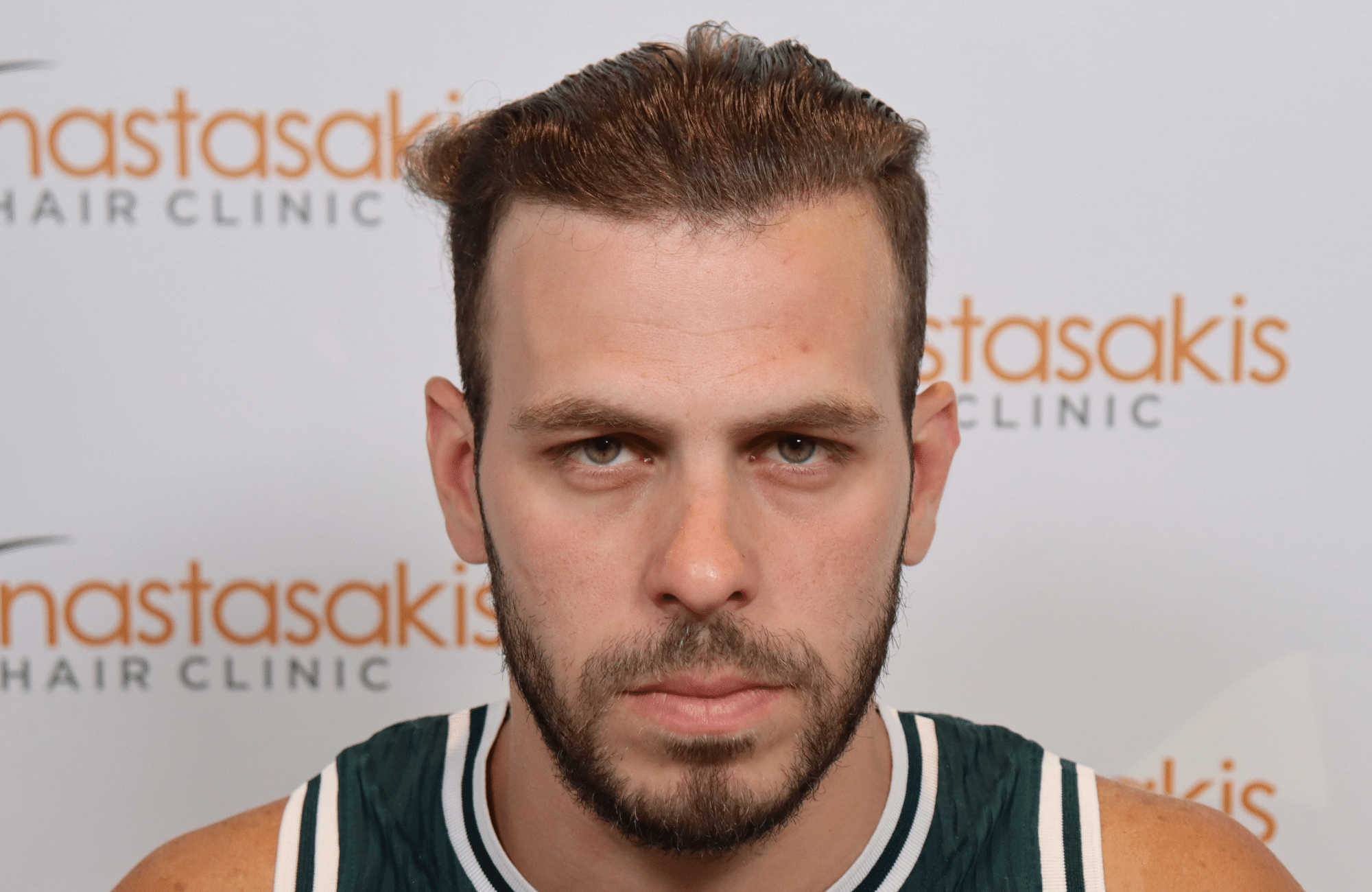 best hair transplant result with 2000 fus male fue anastasakis hair clinic wet hair