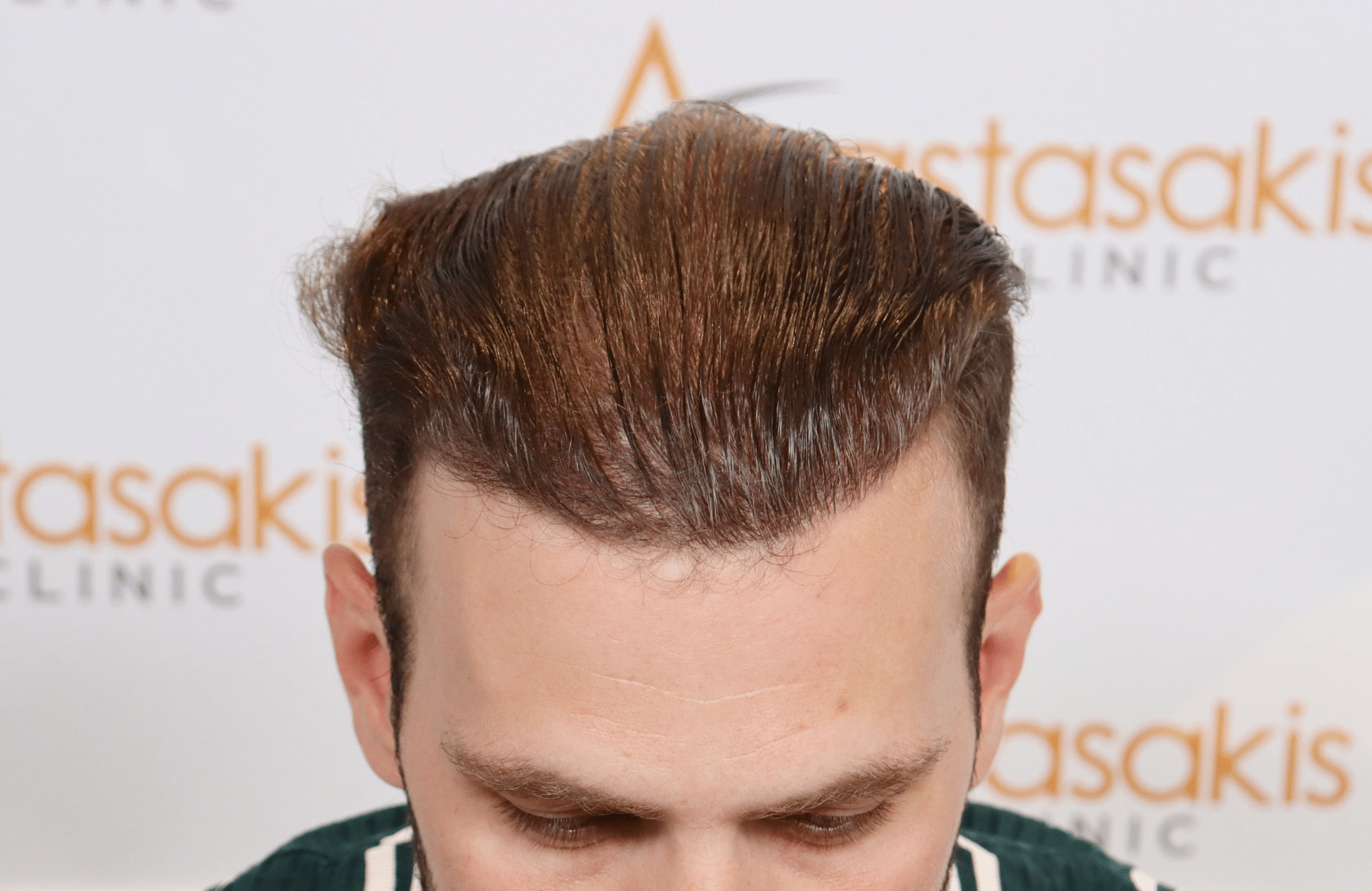 best hair transplant result with 2000 fus male fue anastasakis hair clinic wet hair