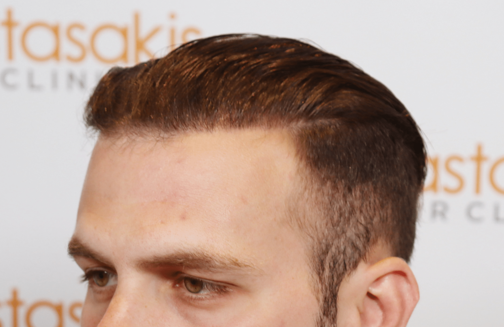 best hair transplant result with 2000 fus male fue anastasakis hair clinic wet hair