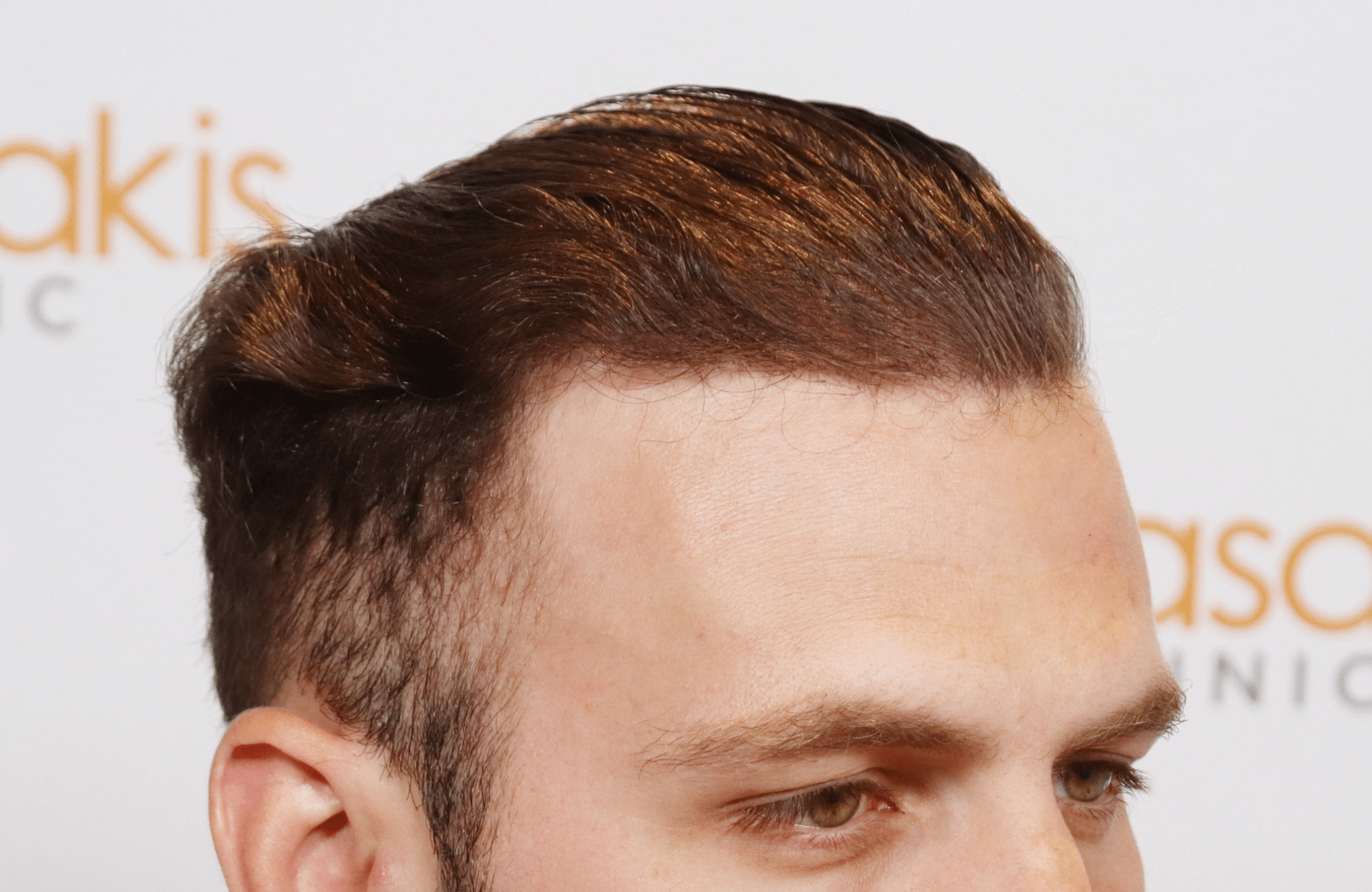 best hair transplant result with 2000 fus male fue anastasakis hair clinic wet hair