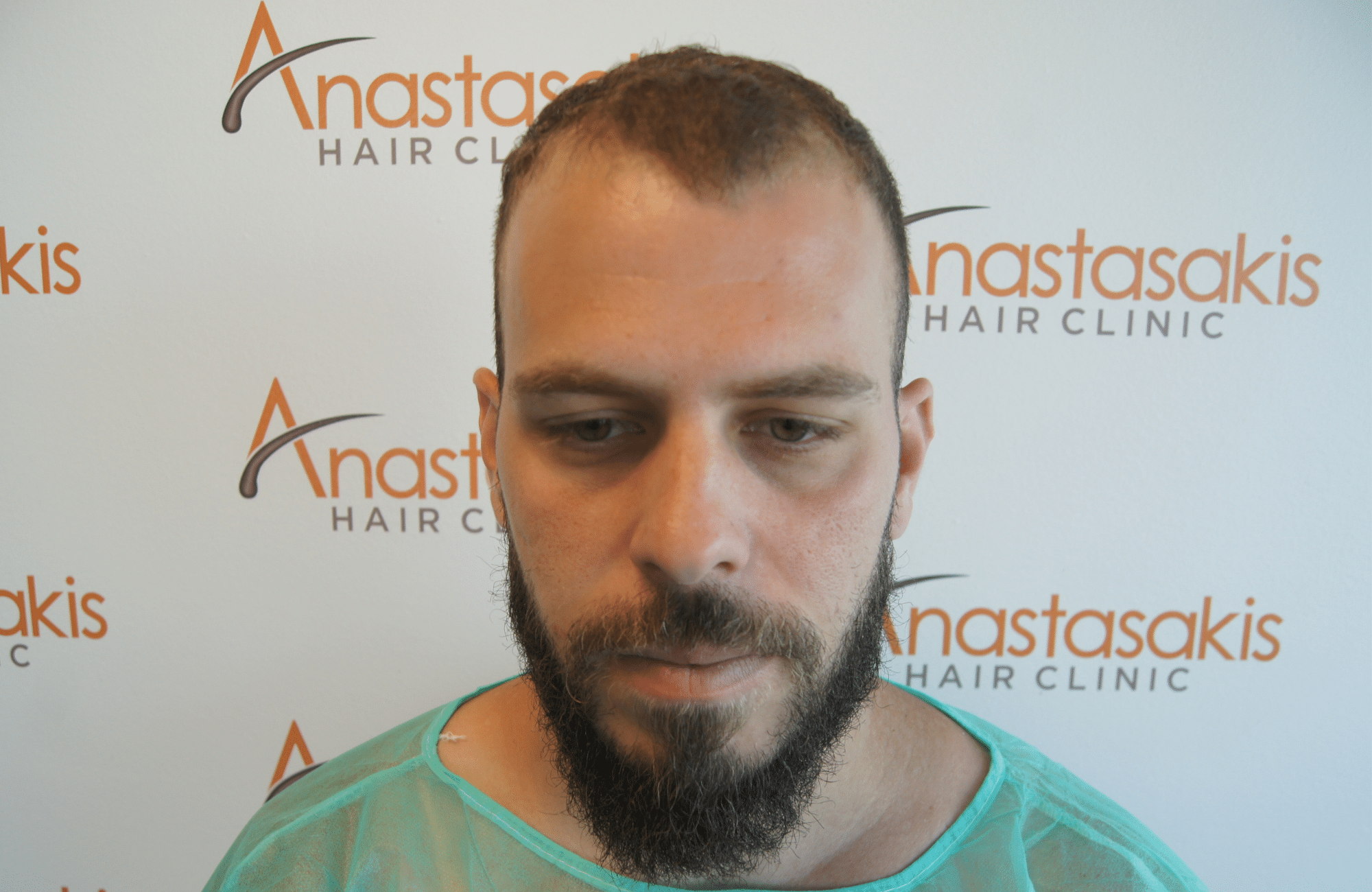 best hair transplant result with 2000 fus male fue anastasakis hair clinic