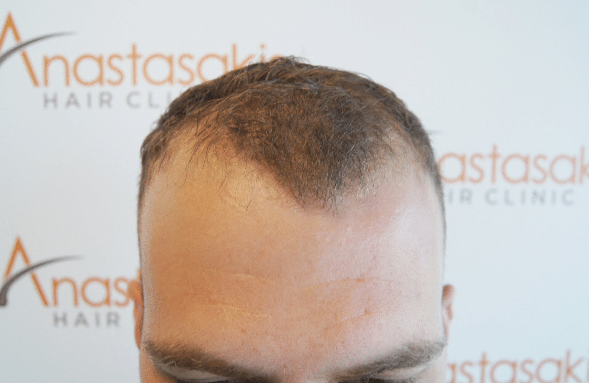 best hair transplant result with 2000 fus male fue anastasakis hair clinic