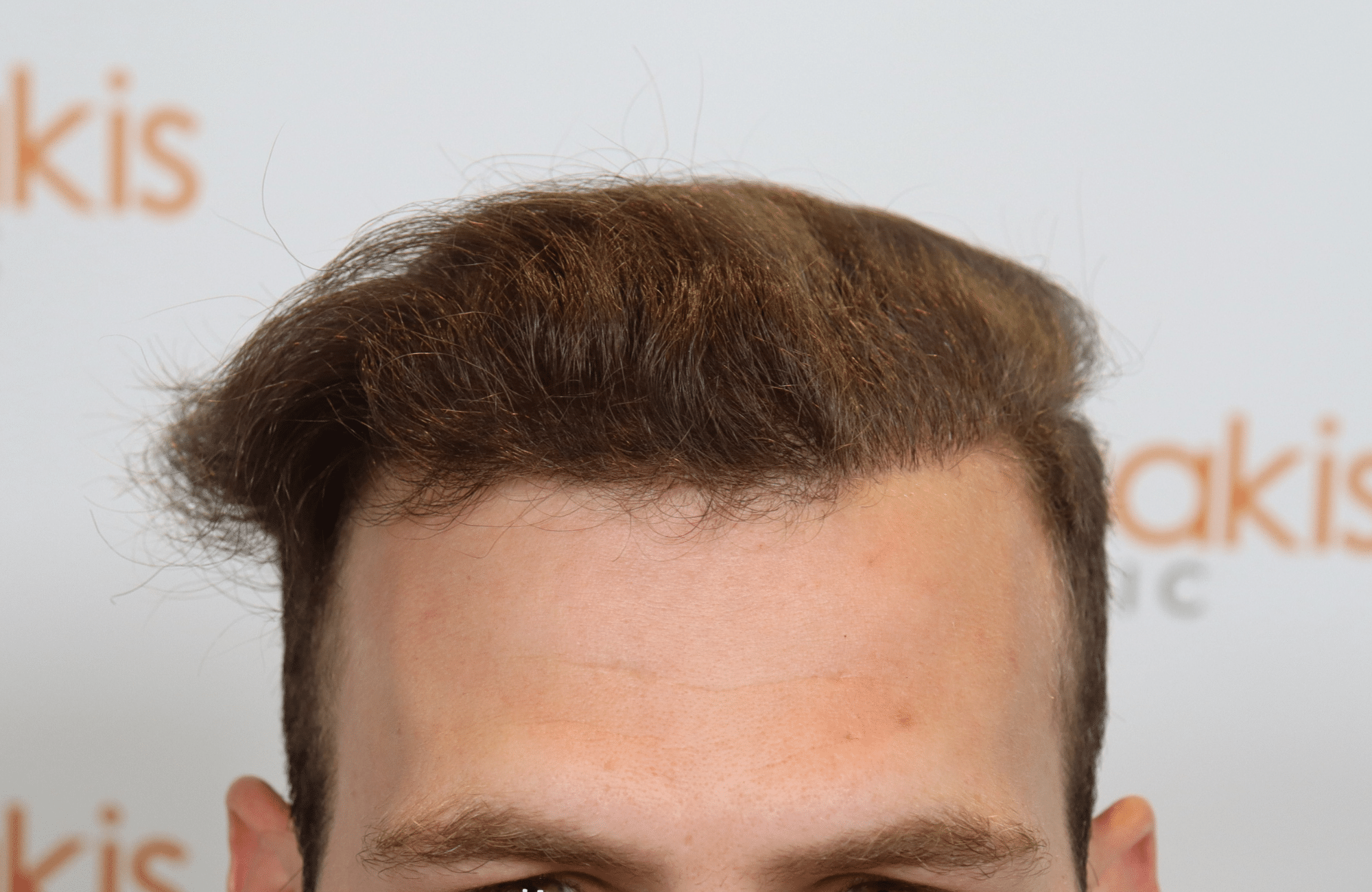 best hair transplant result with 2000 fus male fue anastasakis hair clinic