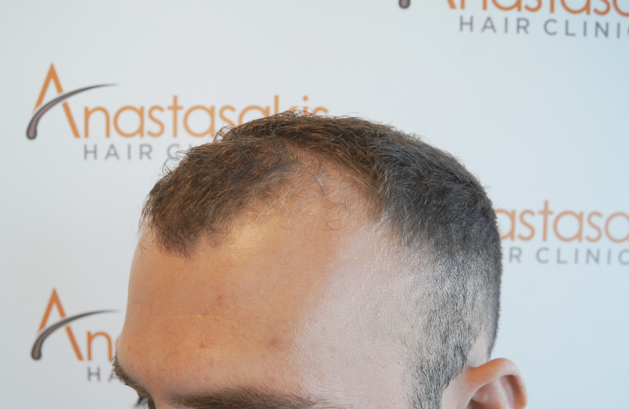 best hair transplant result with 2000 fus male fue anastasakis hair clinic