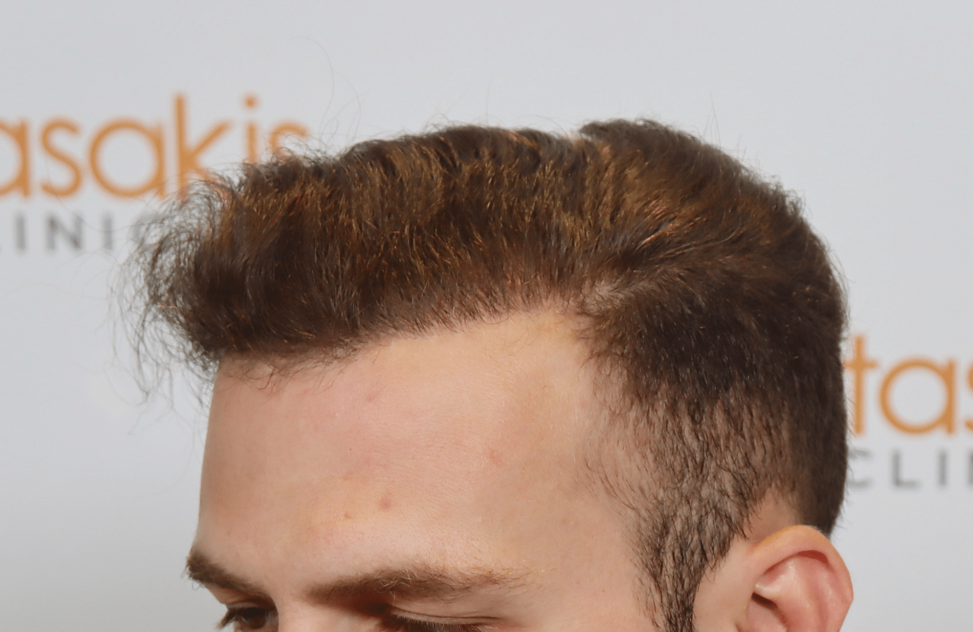 best hair transplant result with 2000 fus male fue anastasakis hair clinic