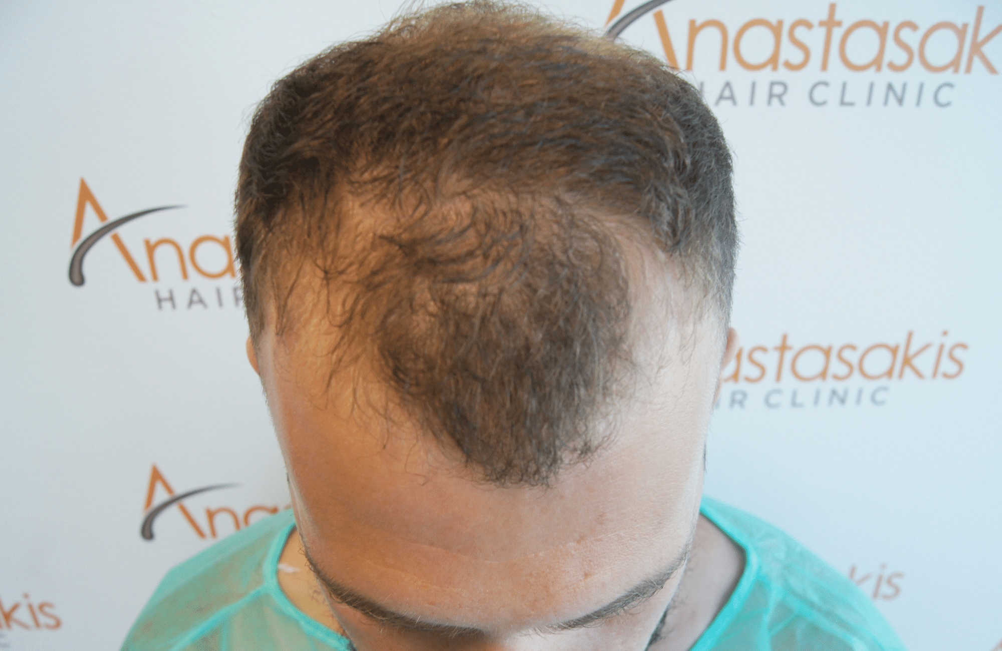 best hair transplant result with 2000 fus male fue anastasakis hair clinic