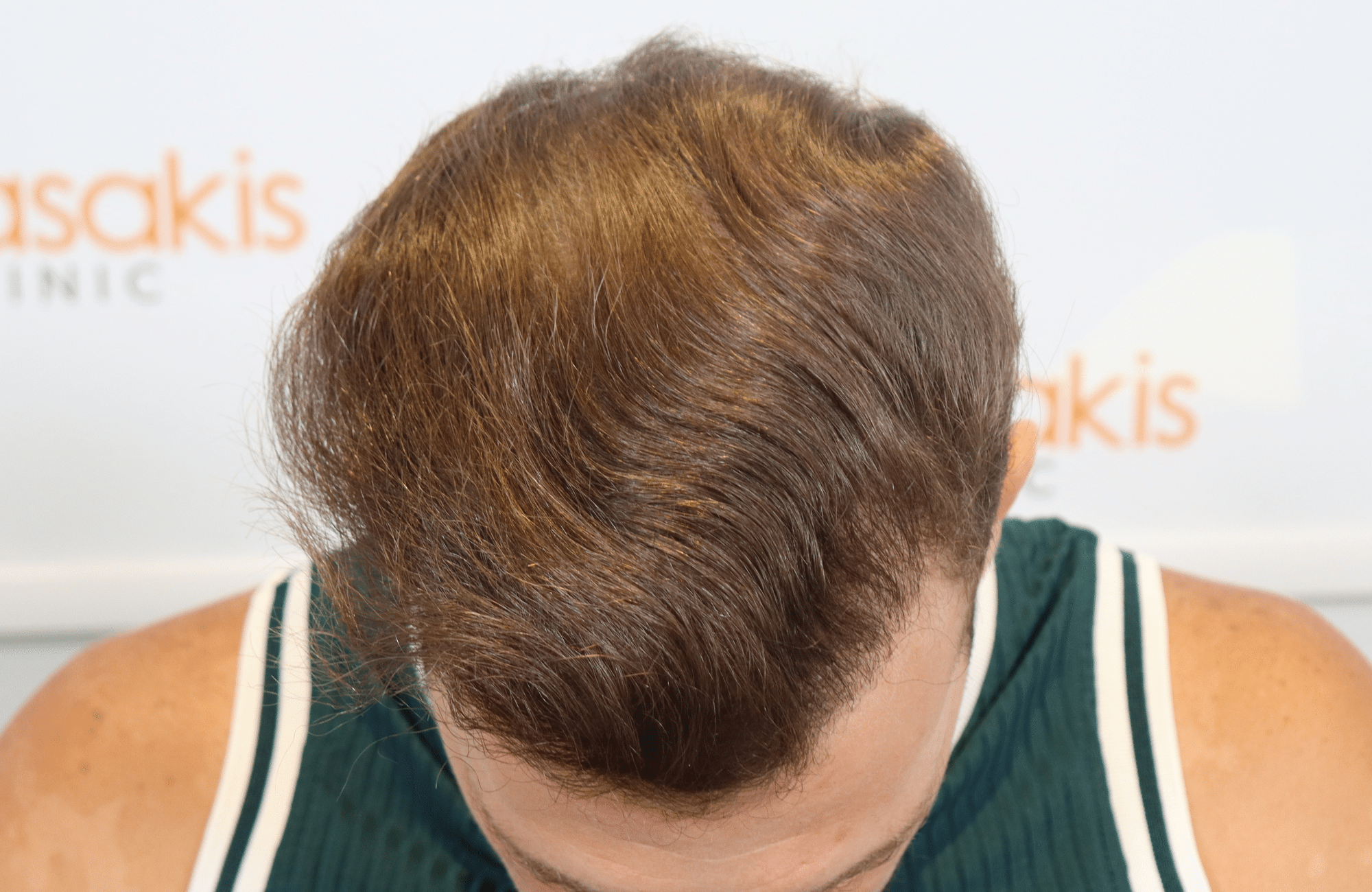 best hair transplant result with 2000 fus male fue anastasakis hair clinic