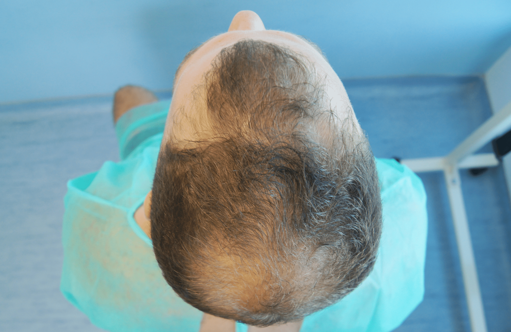 best hair transplant result with 2000 fus male fue anastasakis hair clinic