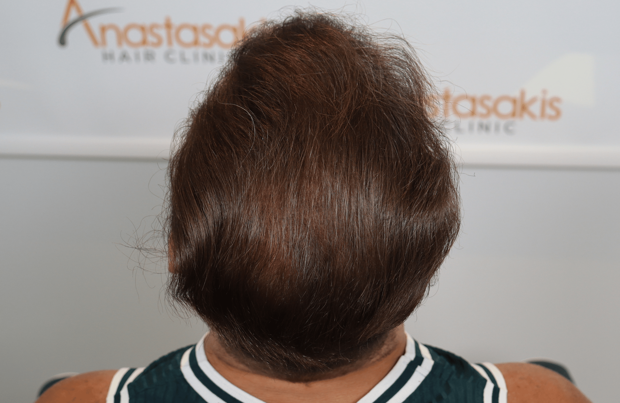best hair transplant result with 2000 fus male fue anastasakis hair clinic