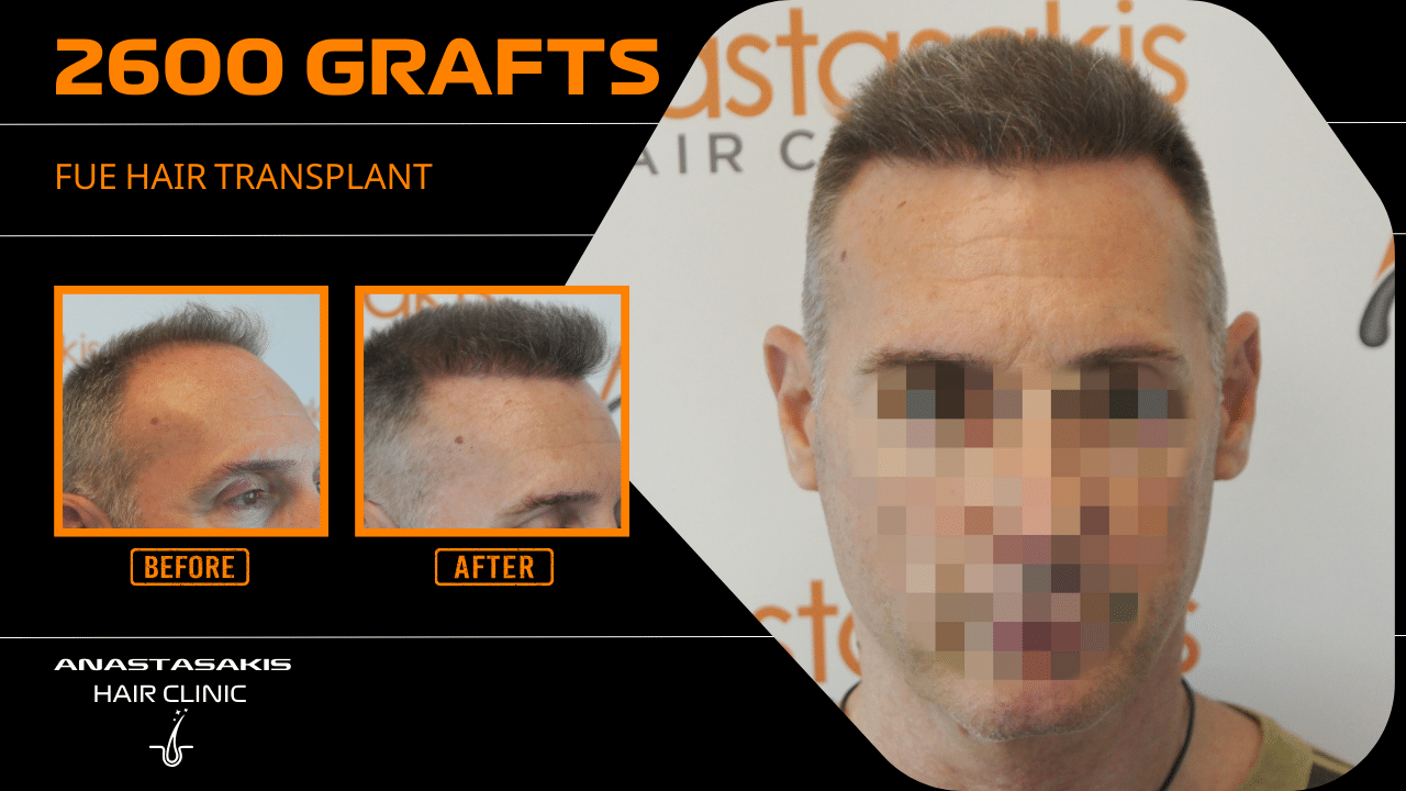 best hair transplant result with 2600 fus male fue anastasakis hair clinic