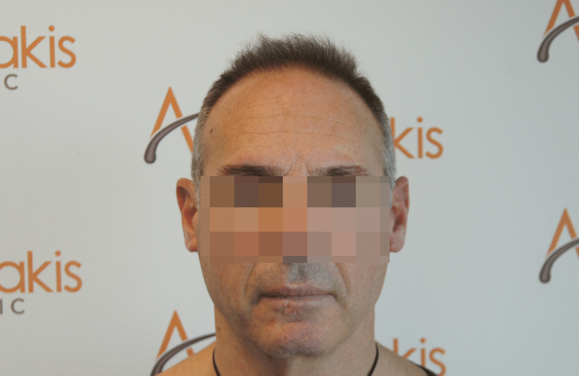 best hair transplant result with 2600 fus male fue anastasakis hair clinic