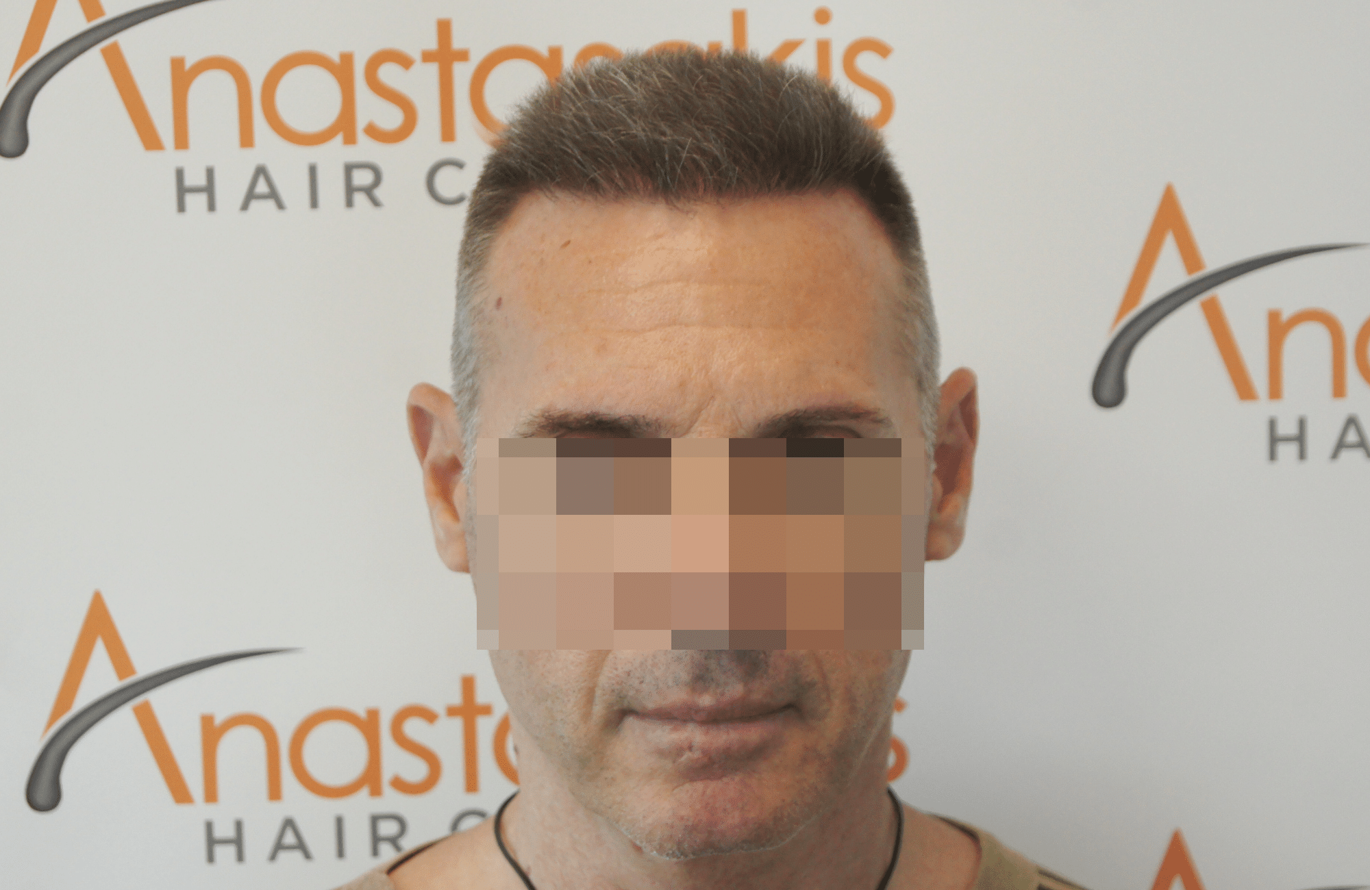 best hair transplant result with 2600 fus male fue anastasakis hair clinic