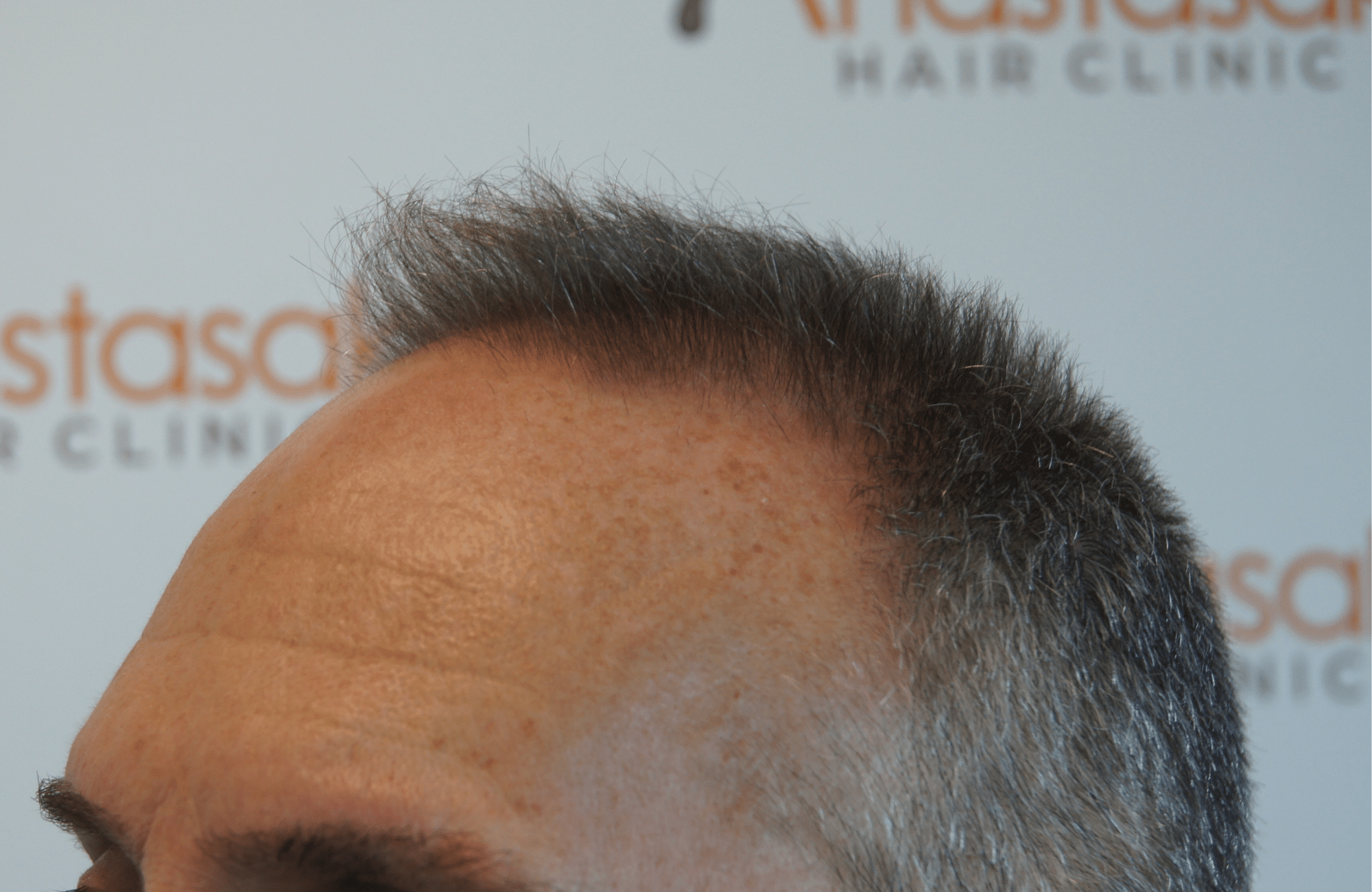 best hair transplant result with 2600 fus male fue anastasakis hair clinic