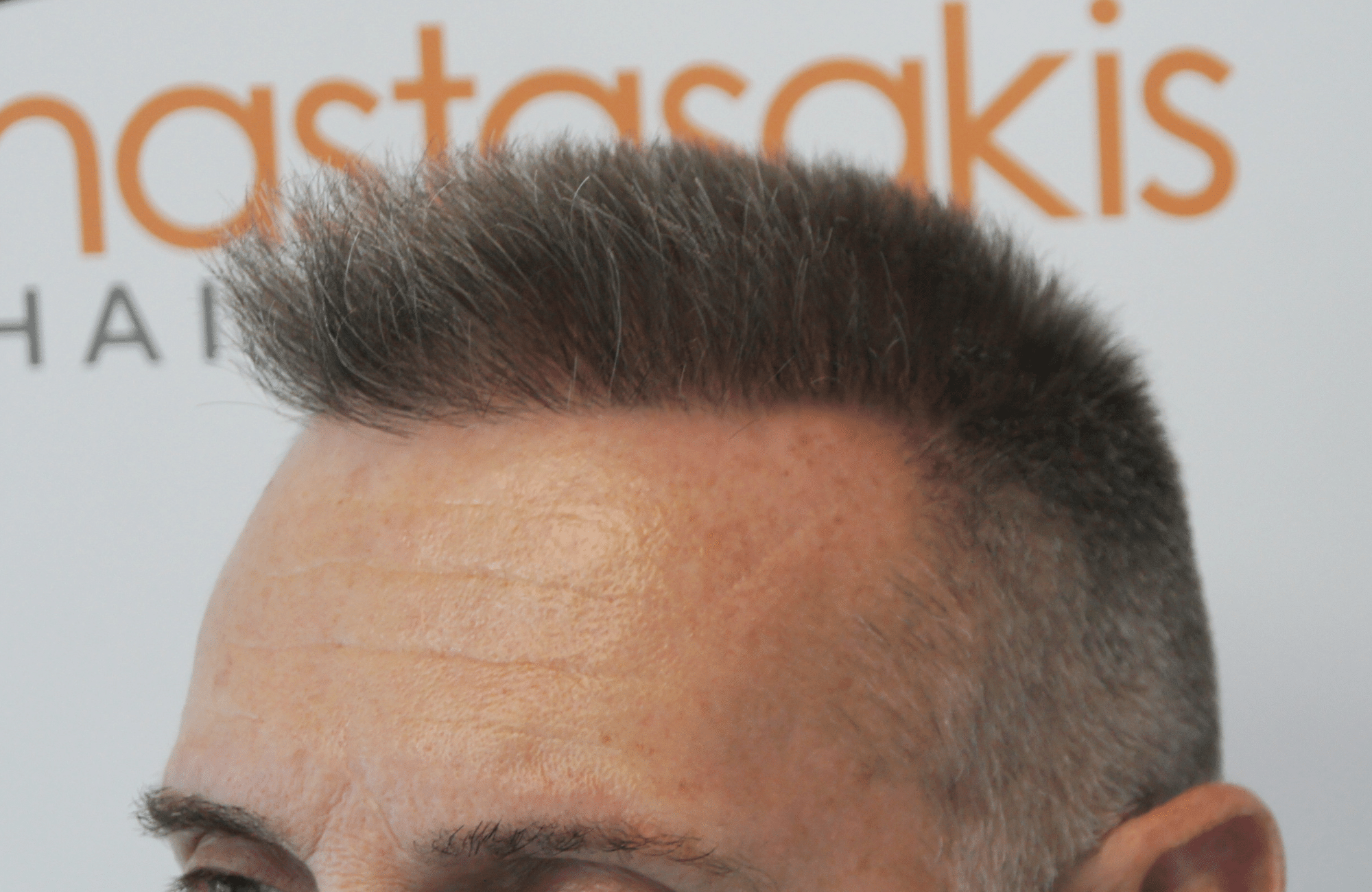 best hair transplant result with 2600 fus male fue anastasakis hair clinic