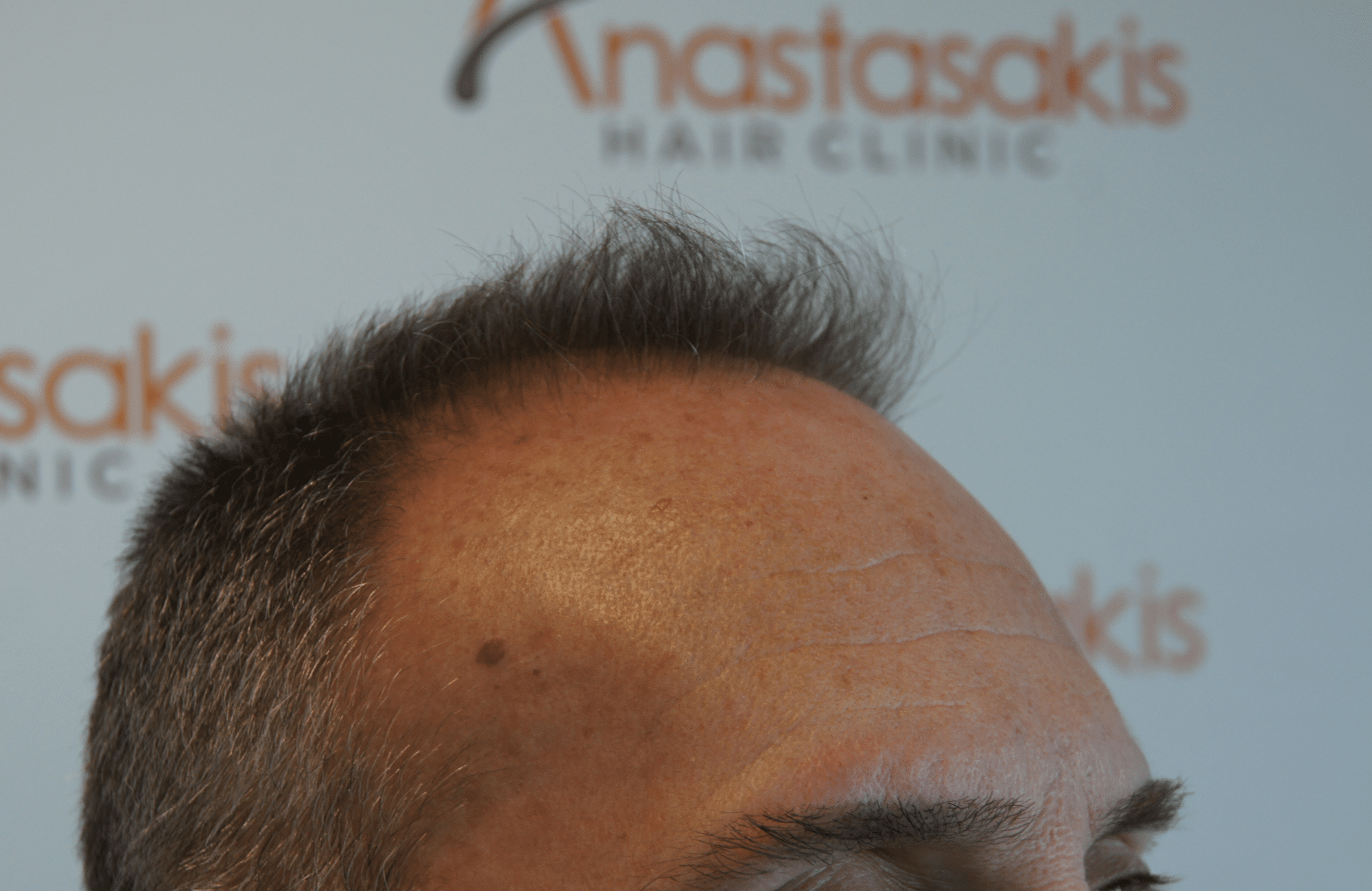 best hair transplant result with 2600 fus male fue anastasakis hair clinic