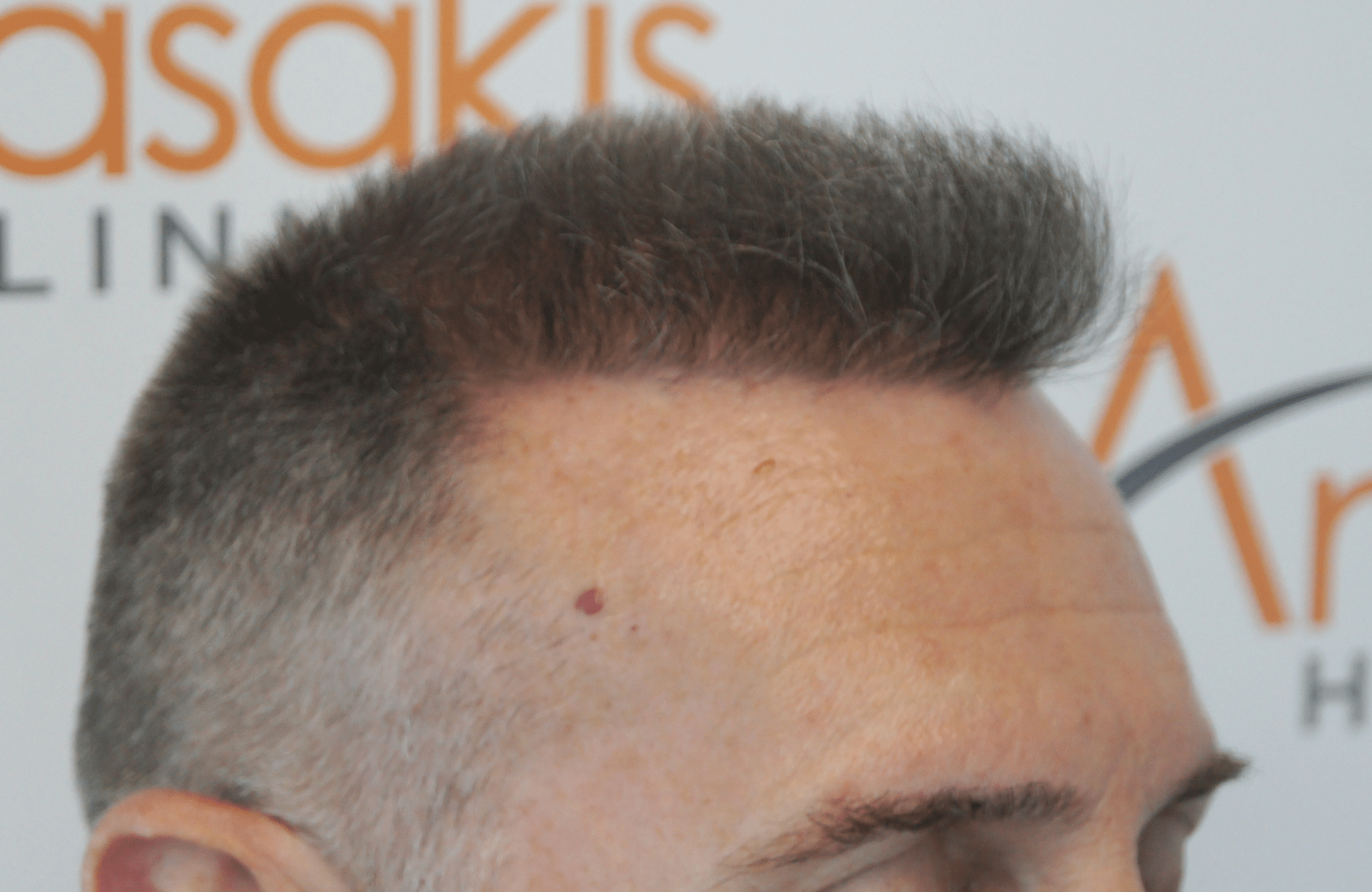 best hair transplant result with 2600 fus male fue anastasakis hair clinic