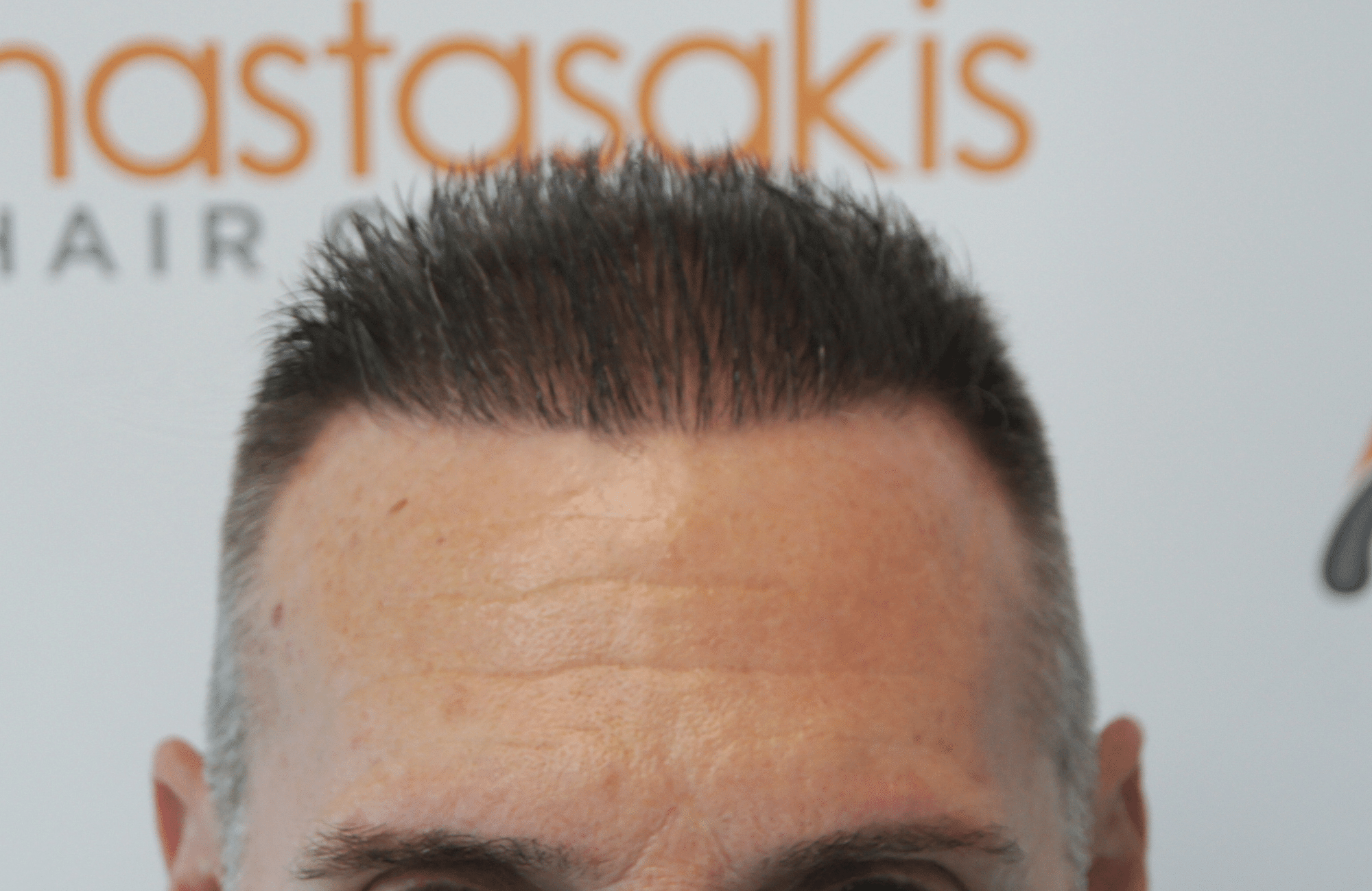 best hair transplant result with 2600 fus male fue anastasakis hair clinic
