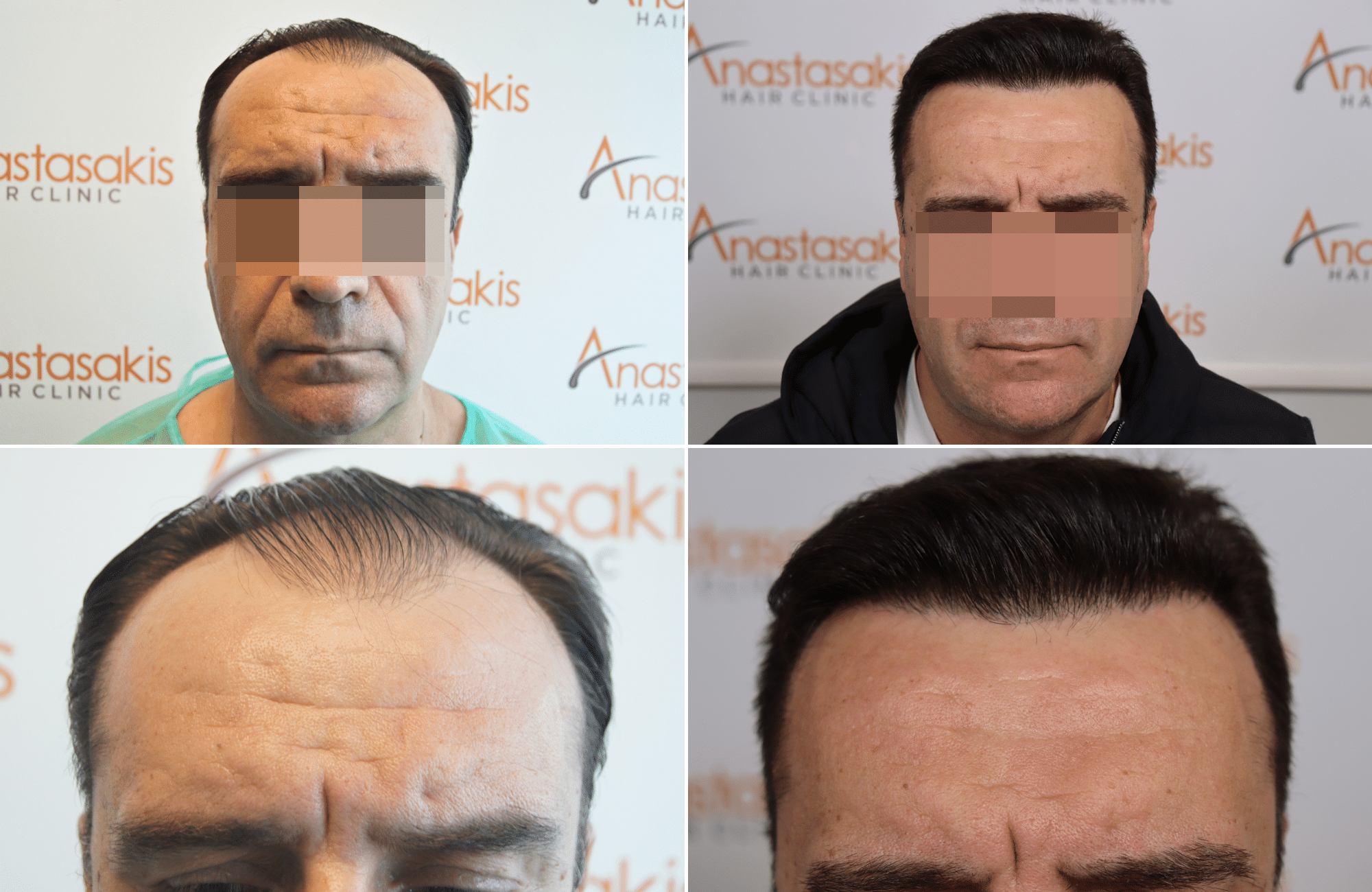 https://www.anastasakishairclinic.gr/portfolio/apotelesma-metamosxefsis-mallion-anastasakis-hair-clinic-500/